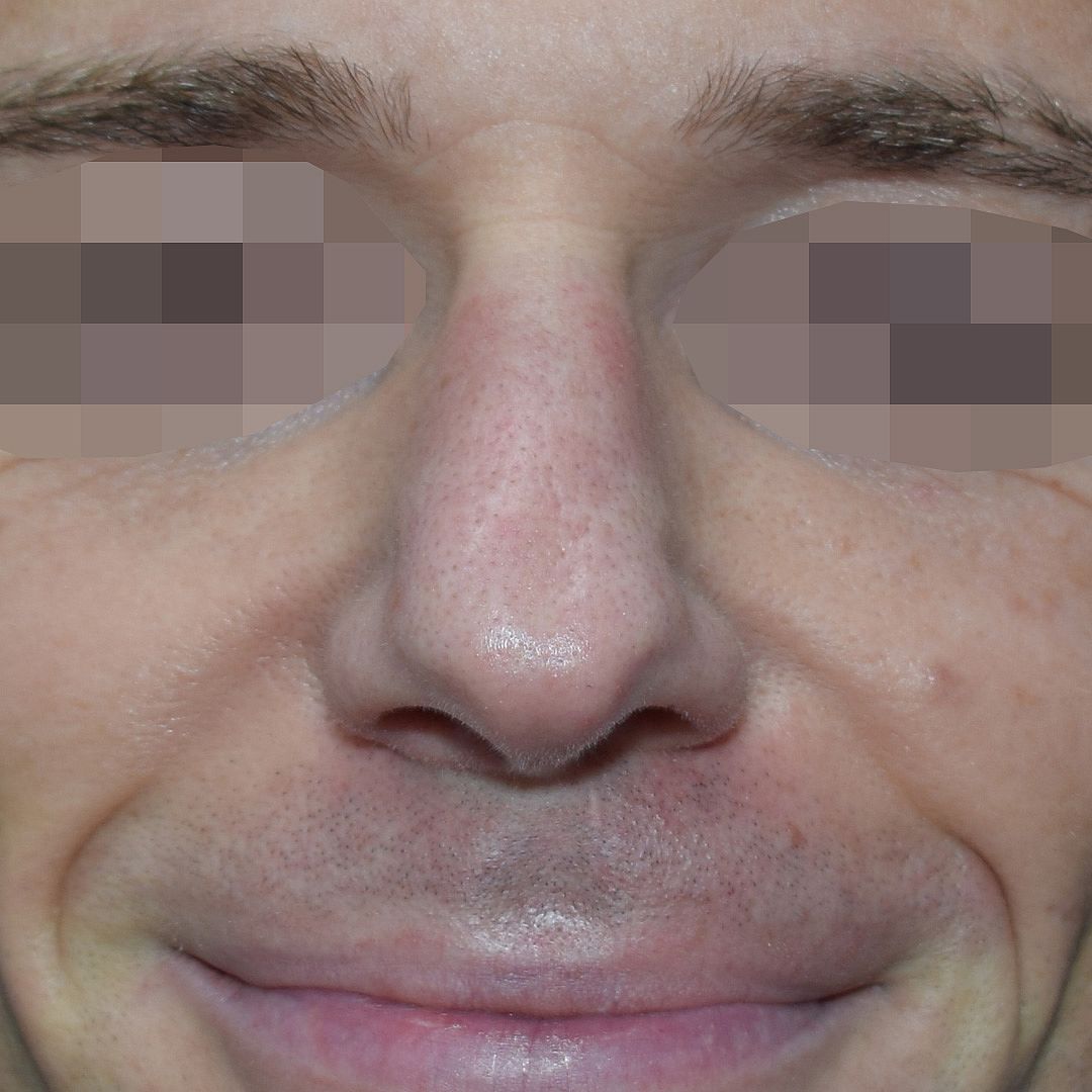 Nasenkorrektur Vorher (1)