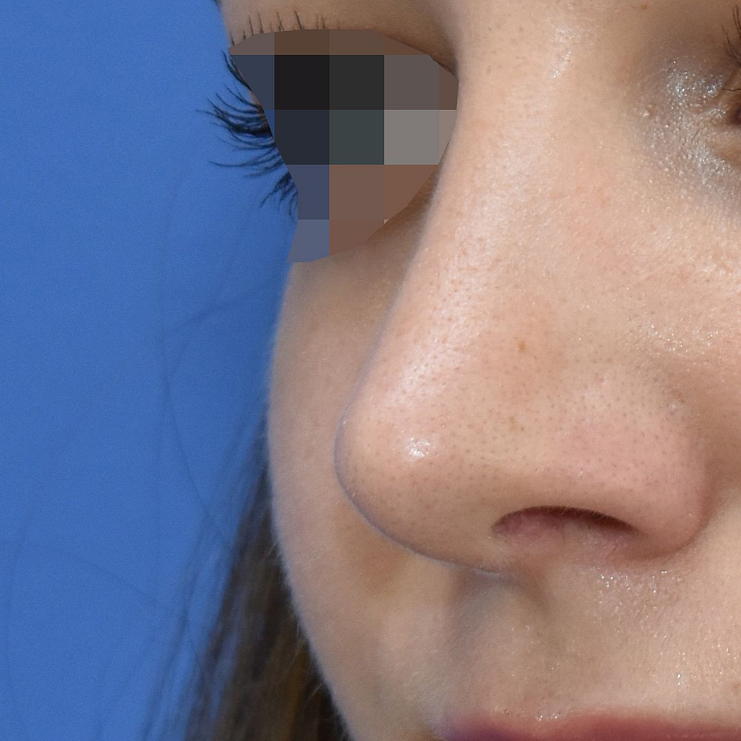Nasenkorrektur Nachher (2)