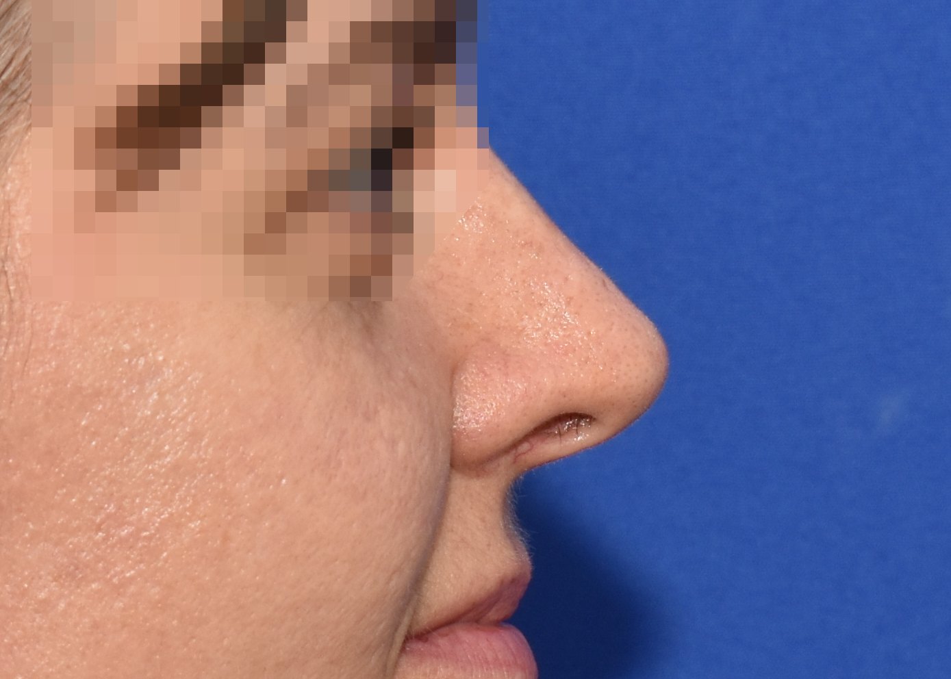 Rhinoplasty after, profile view: Dorsal hump — Case 90001, 38 Years