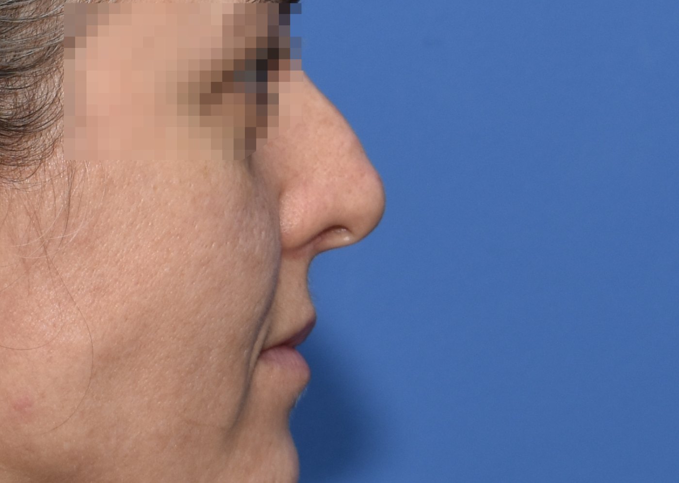 Rhinoplasty before, profile view: Dorsal hump — Case 90001, 38 Years