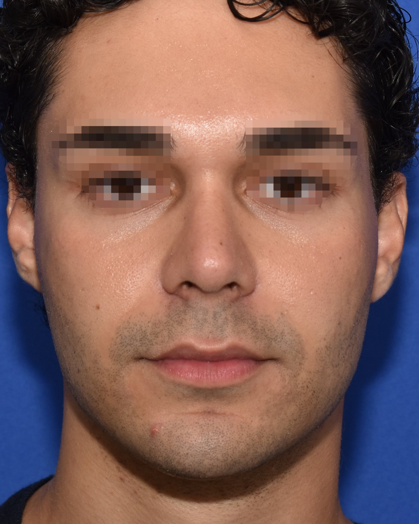 Rhinoplasty after, frontal view: Dorsal hump, Nasal tip, Crooked nose — Case 90002, 26 Years