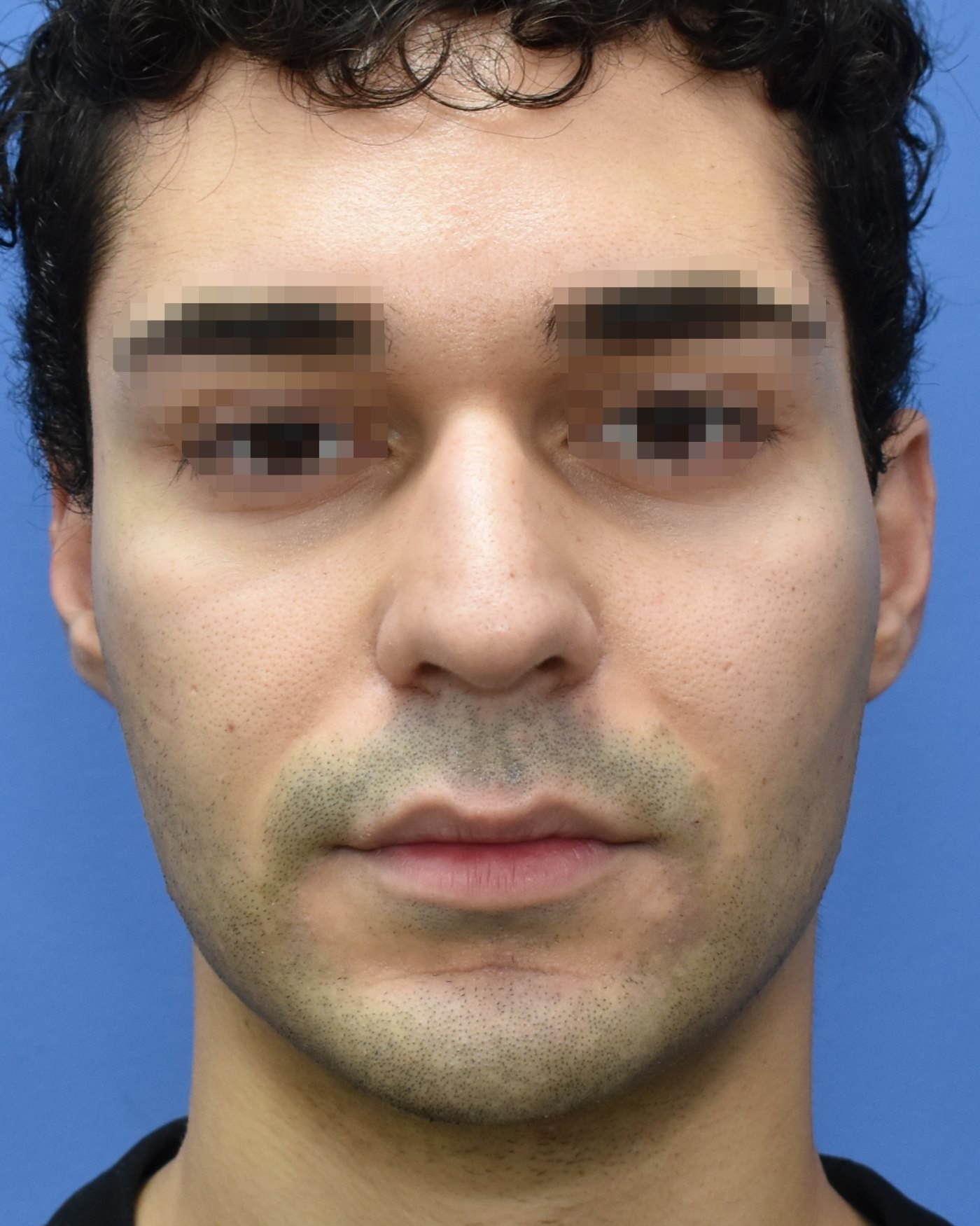 Rhinoplasty before, frontal view: Dorsal hump, Nasal tip, Crooked nose — Case 90002, 26 Years