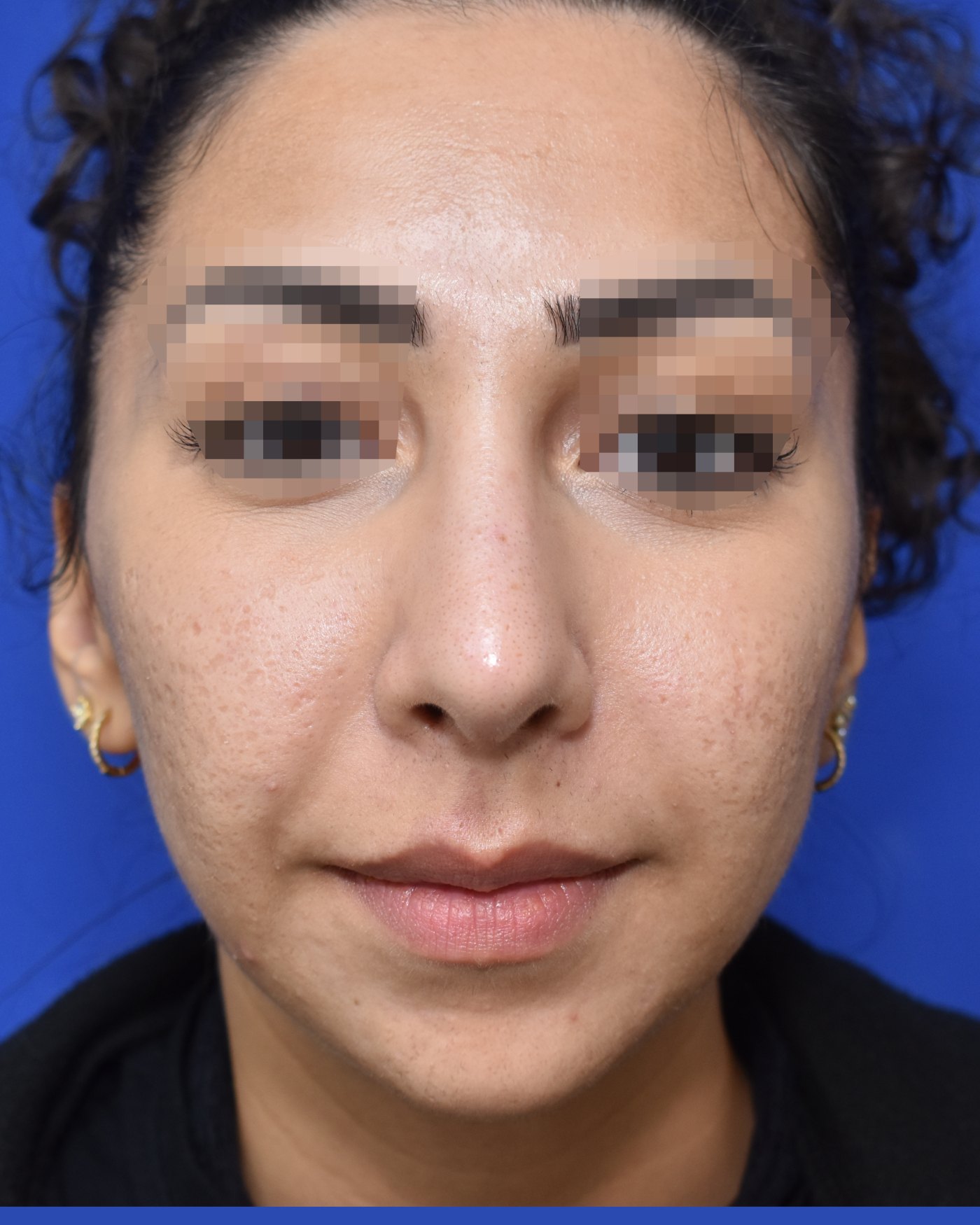 Rhinoplasty after, frontal view: Nasal breathing — Case 90008, 25 Years