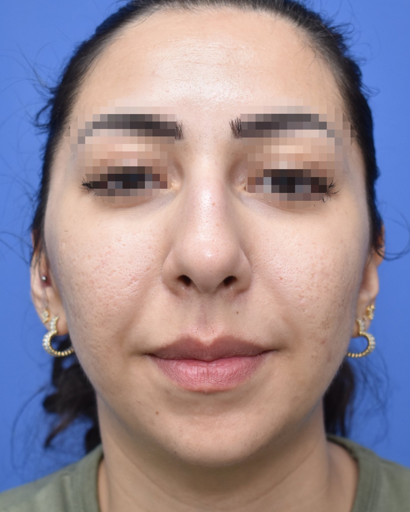 Rhinoplasty before, frontal view: Nasal breathing — Case 90008, 25 Years