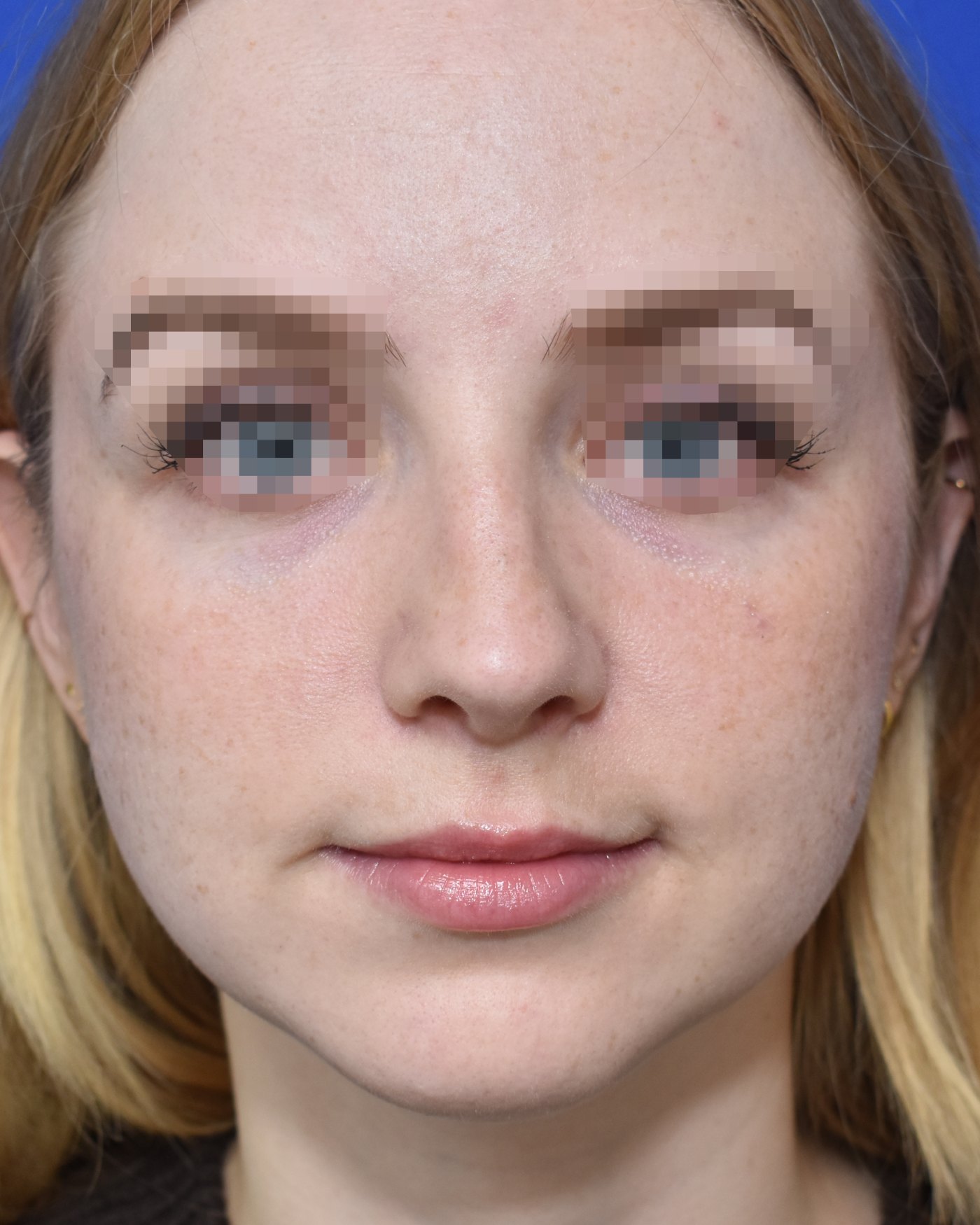 Rhinoplasty after, frontal view: Revision surgery — Case 90009, 26 Years