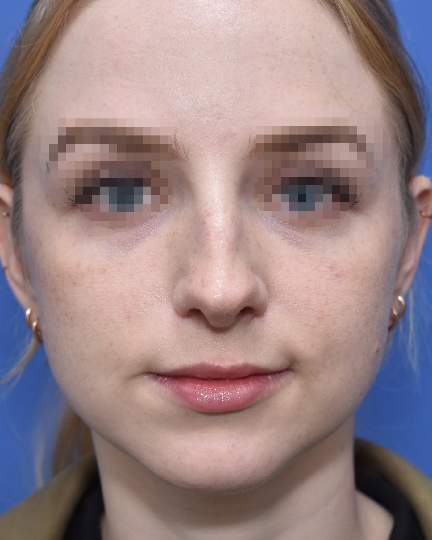 Rhinoplasty before, frontal view: Revision surgery — Case 90009, 26 Years