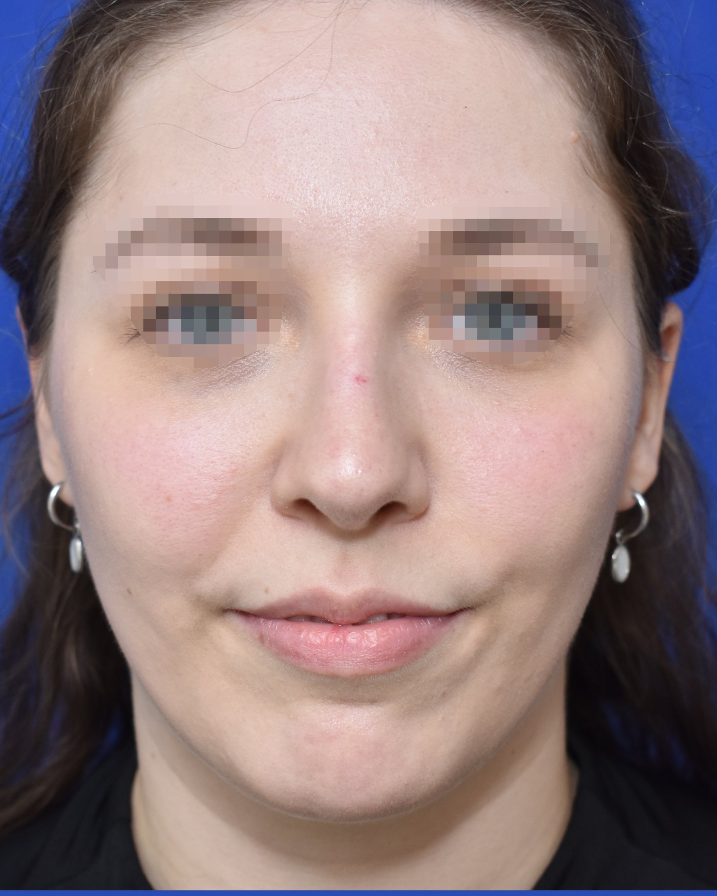 Rhinoplasty after, frontal view: Dorsal hump — Case 90010, 27 Years