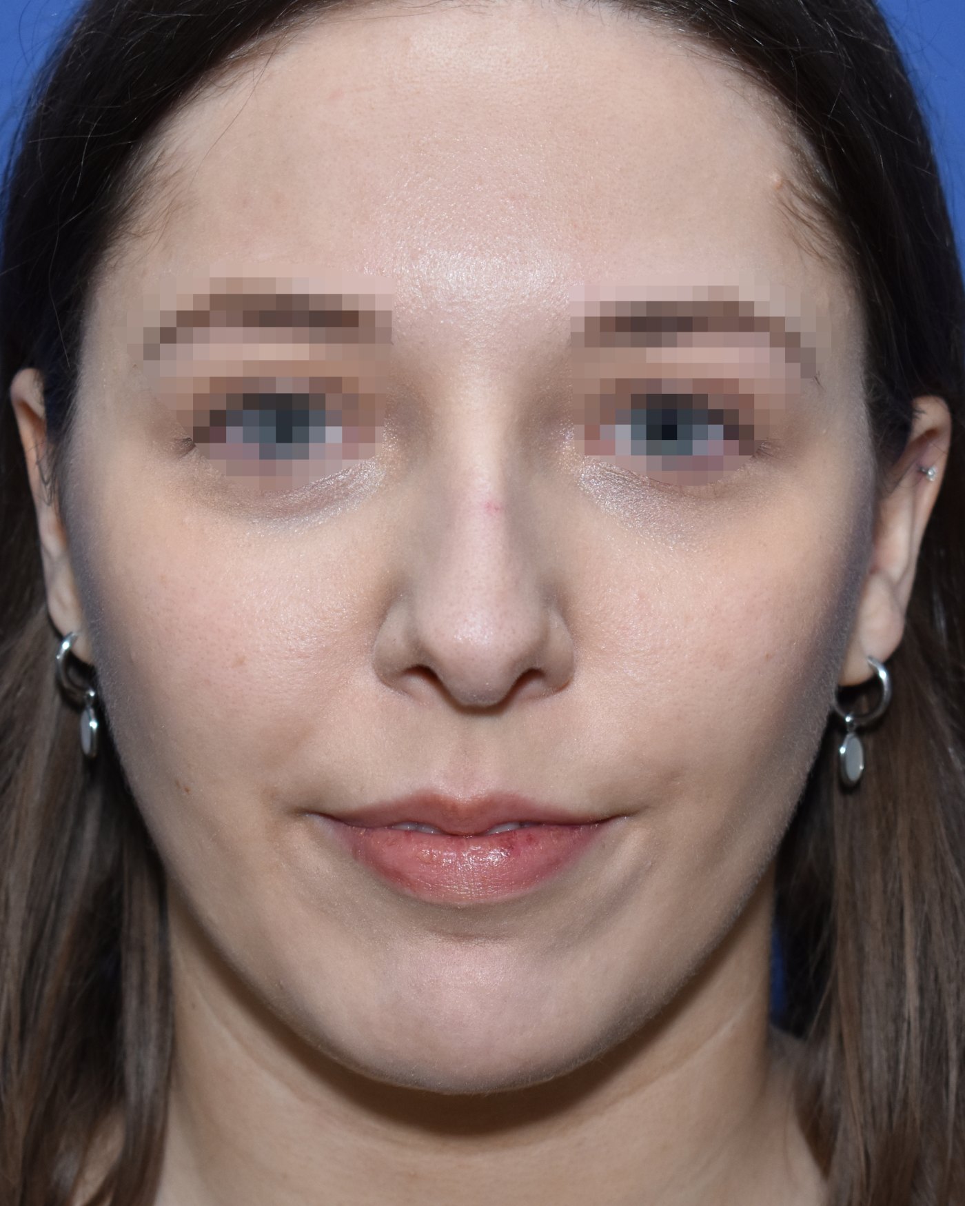 Rhinoplasty before, frontal view: Dorsal hump — Case 90010, 27 Years