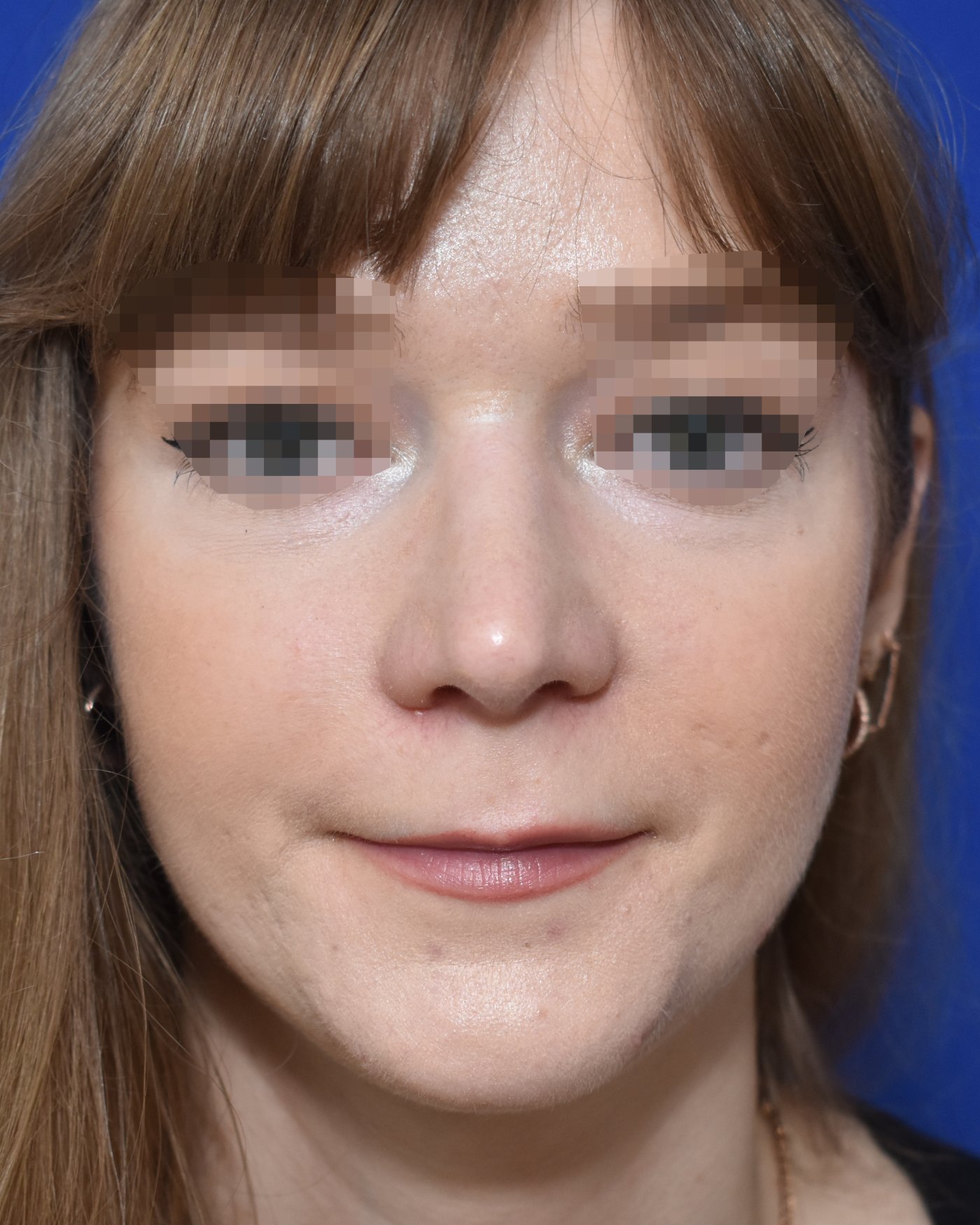 Rhinoplasty after, frontal view — Case 90012, 33 Years