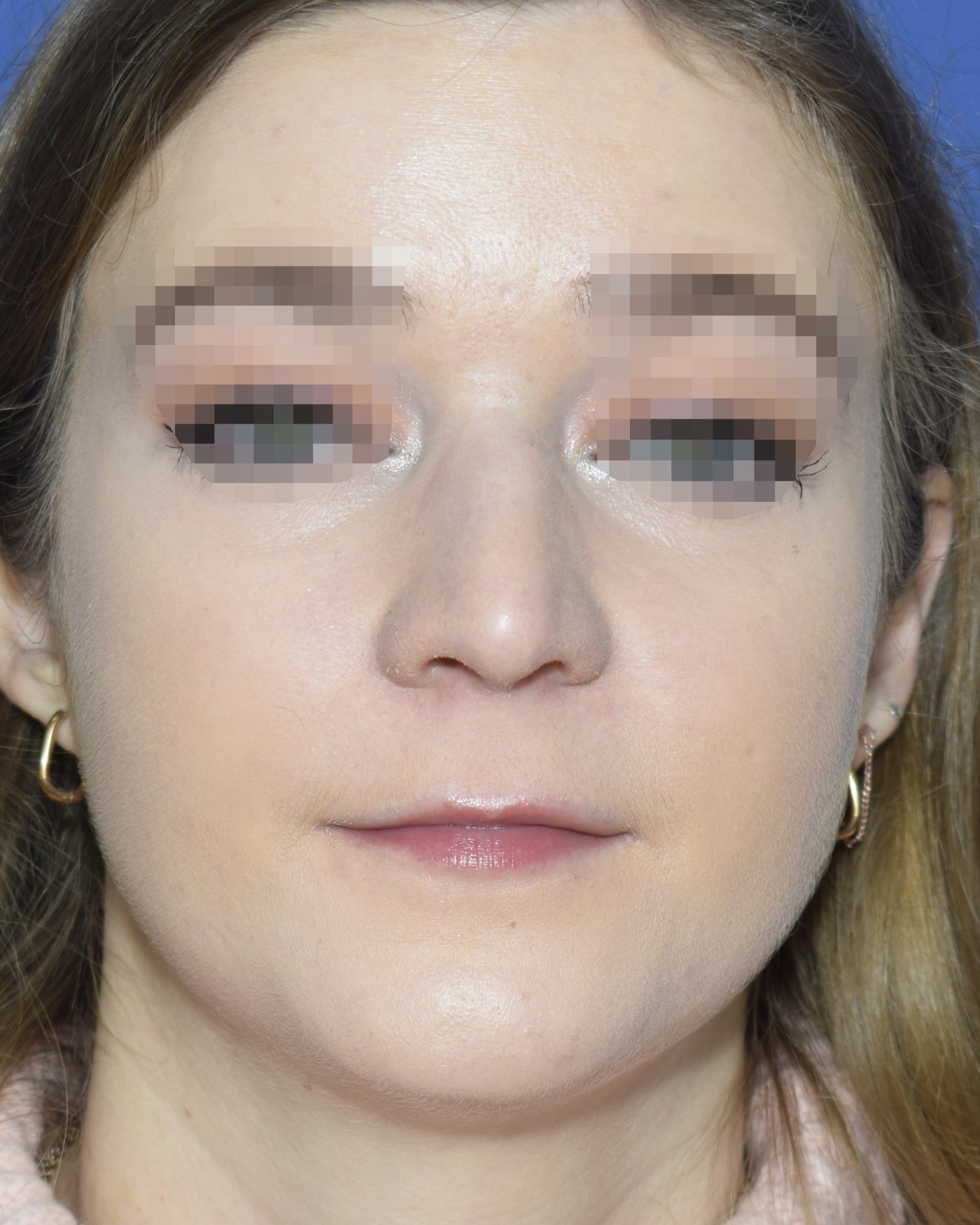 Rhinoplasty before, frontal view — Case 90012, 33 Years