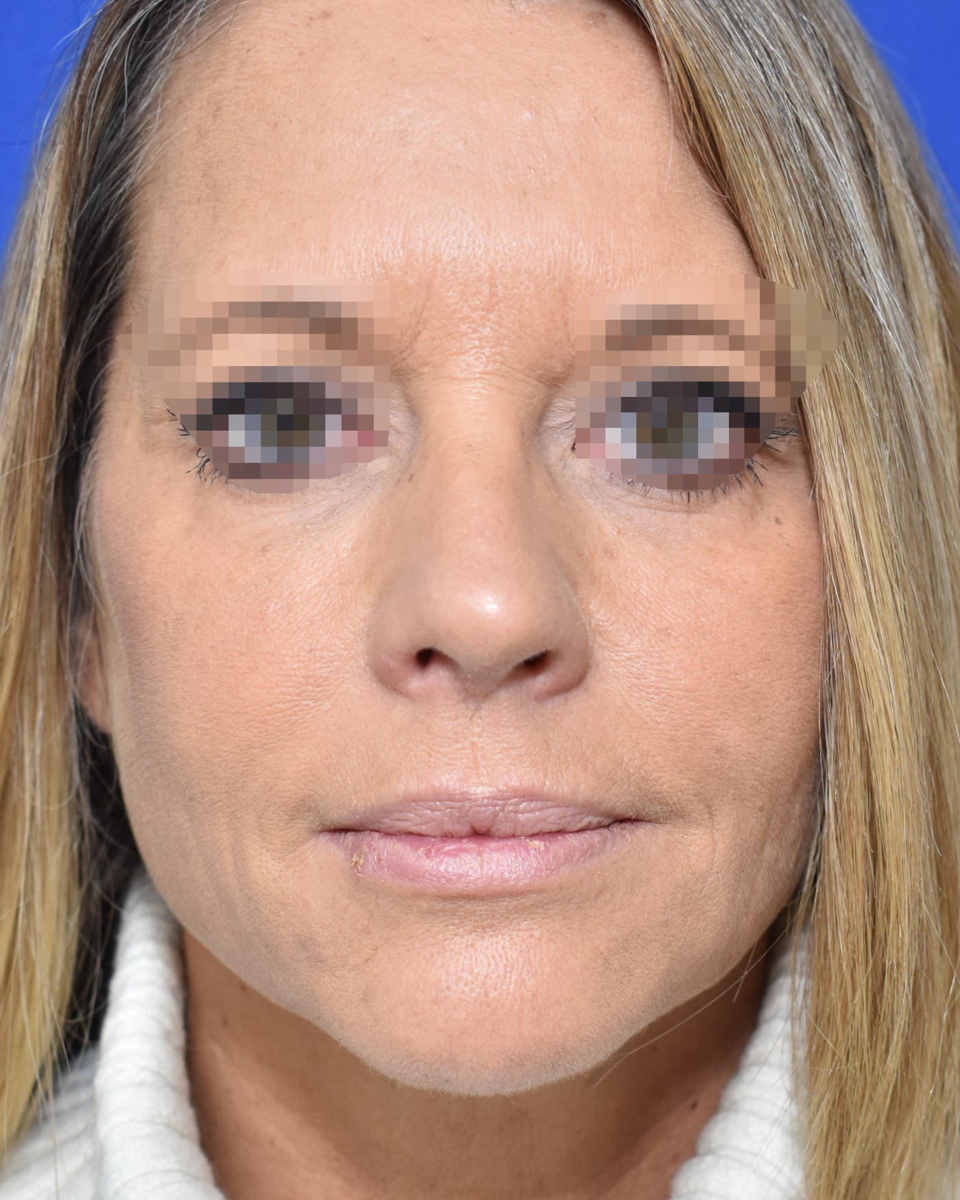 Rhinoplasty after, frontal view — Case 90013, 52 Years