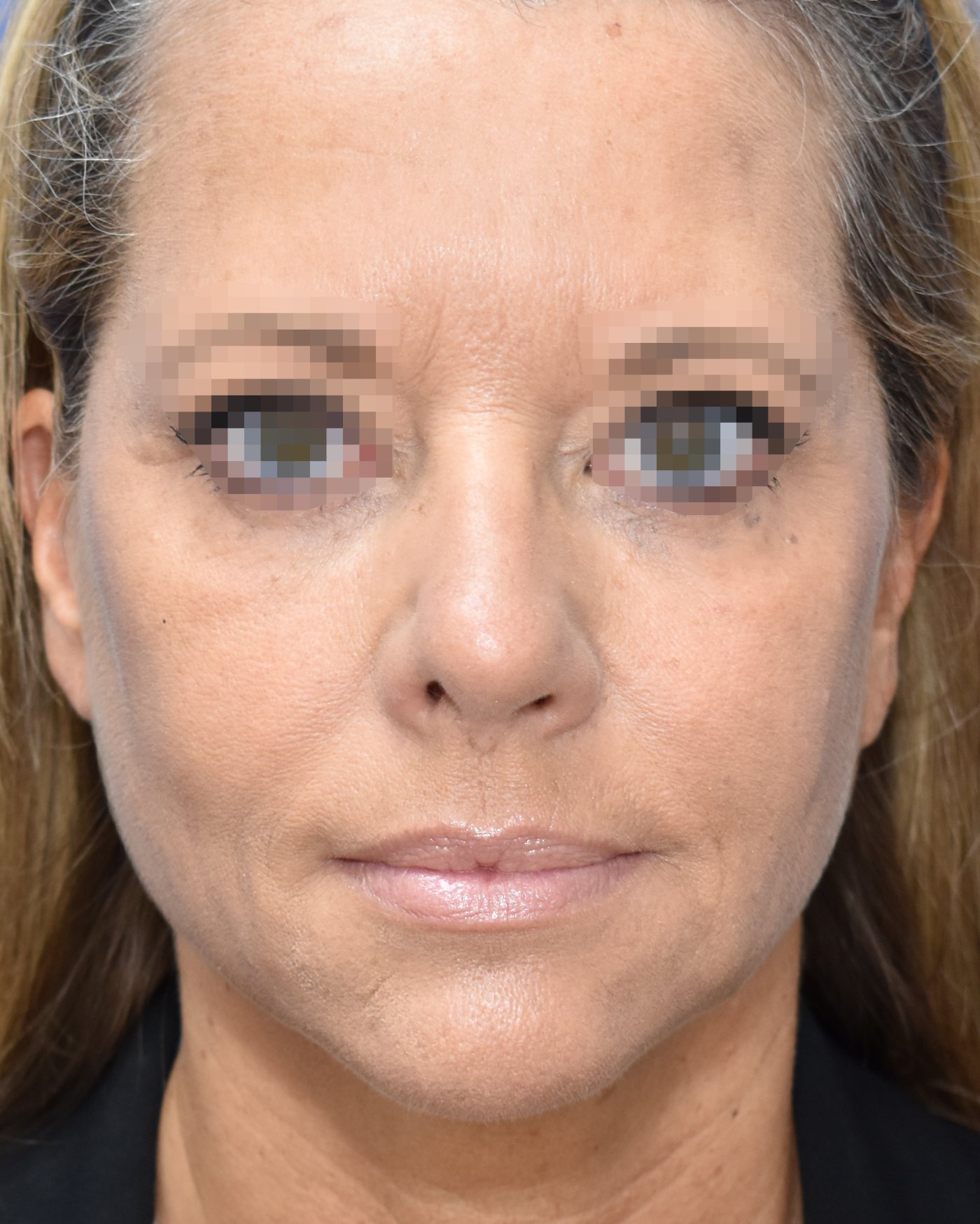 Rhinoplasty before, frontal view — Case 90013, 52 Years
