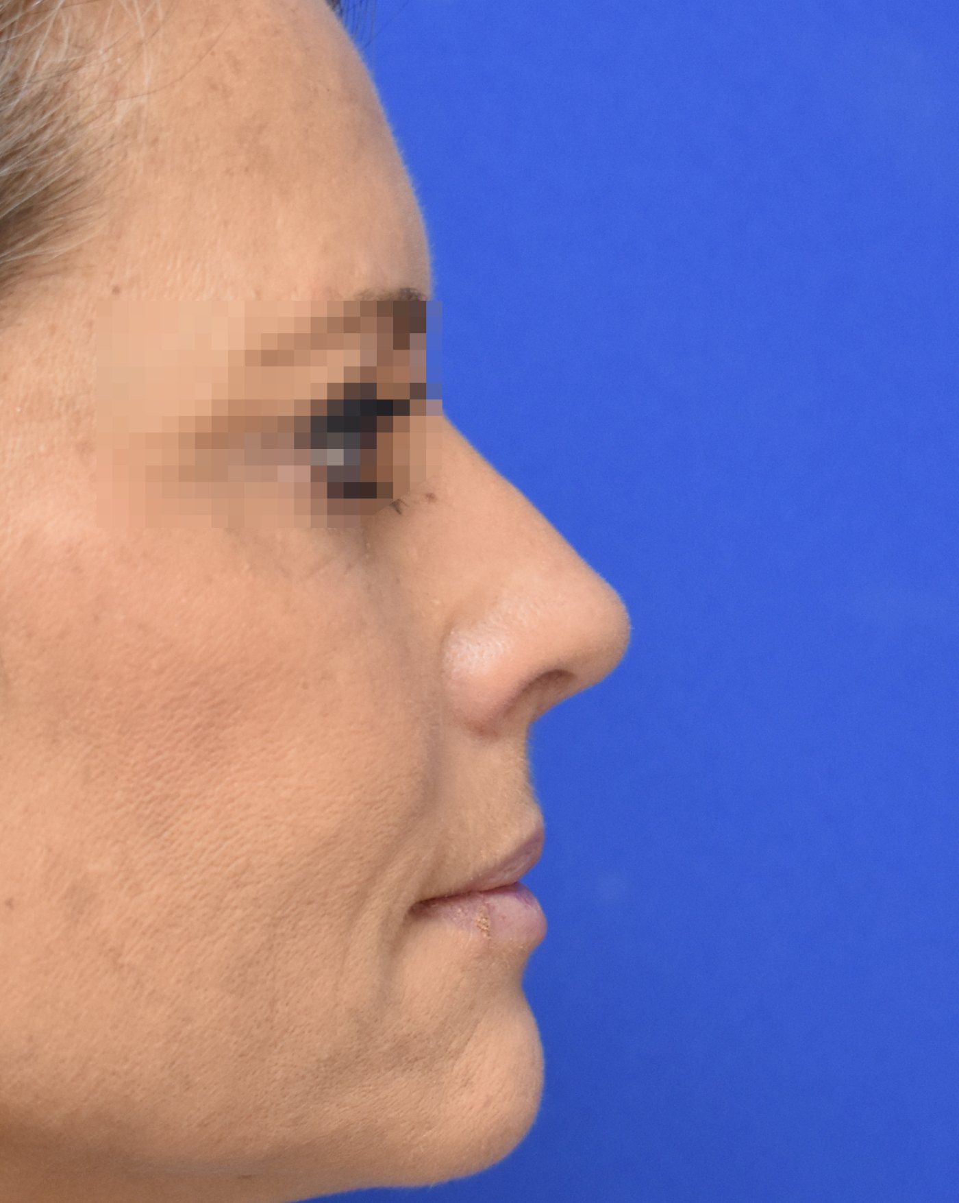 Rhinoplasty after, profile view — Case 90013, 52 Years