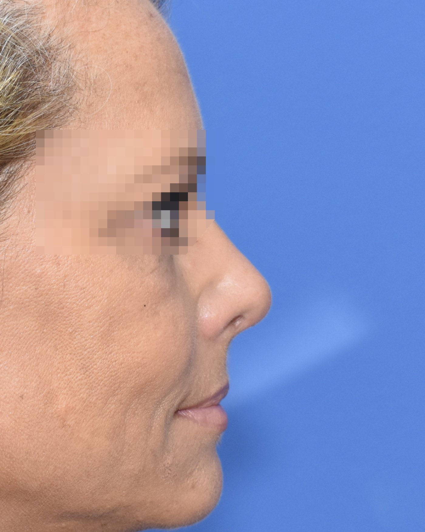 Rhinoplasty before, profile view — Case 90013, 52 Years