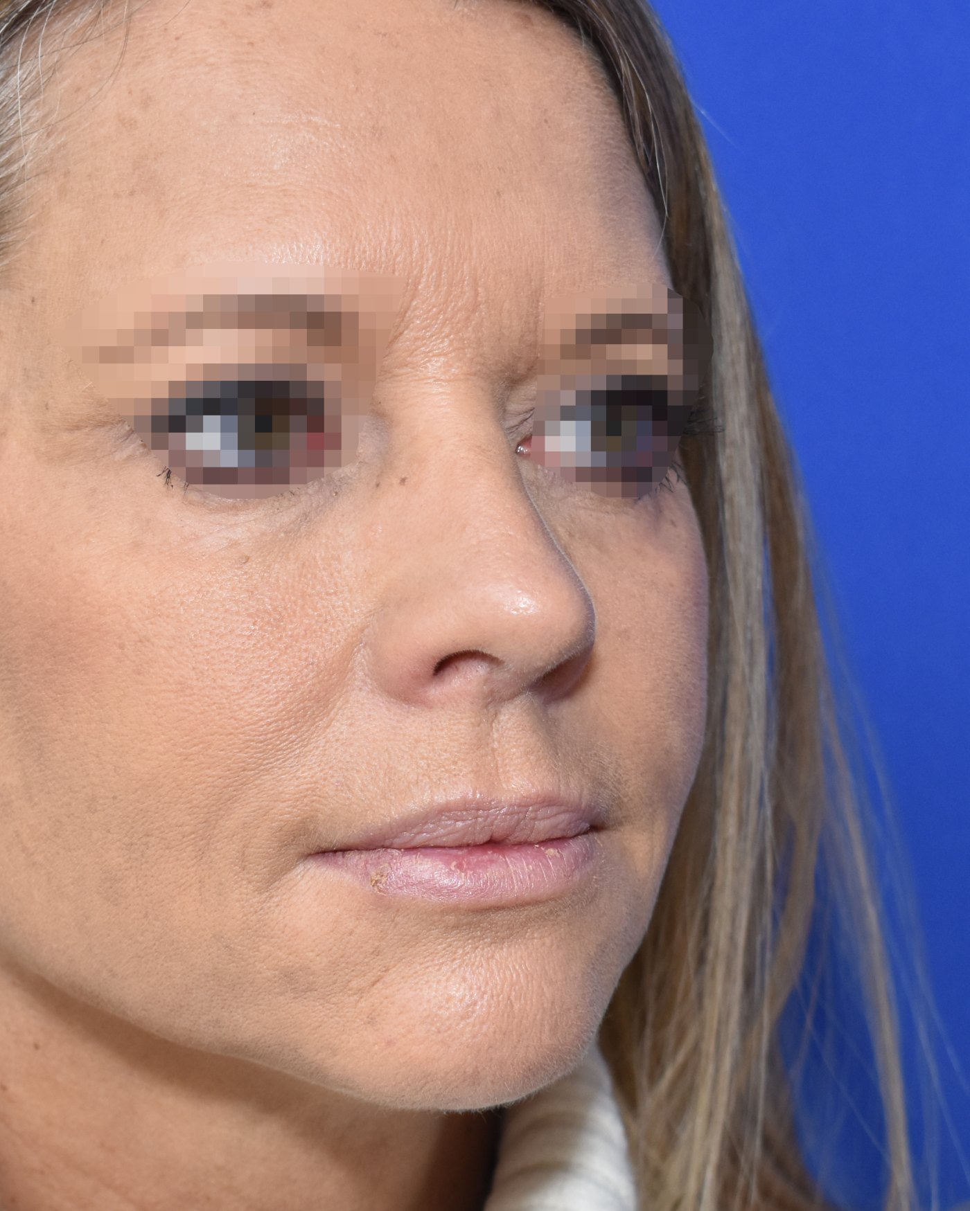 Rhinoplasty after, three-quarter view (45°) — Case 90013, 52 Years