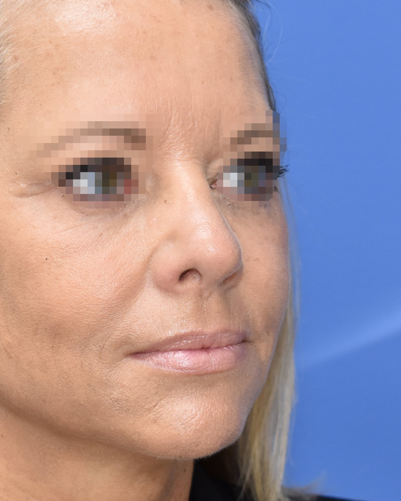 Rhinoplasty before, three-quarter view (45°) — Case 90013, 52 Years