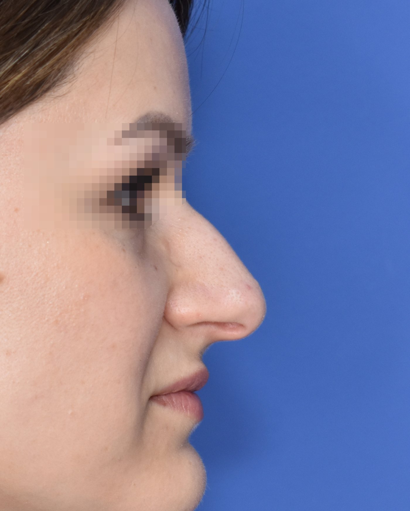 Nasenkorrektur vorher, Profilansicht — Fall 90015, 34 Jahre