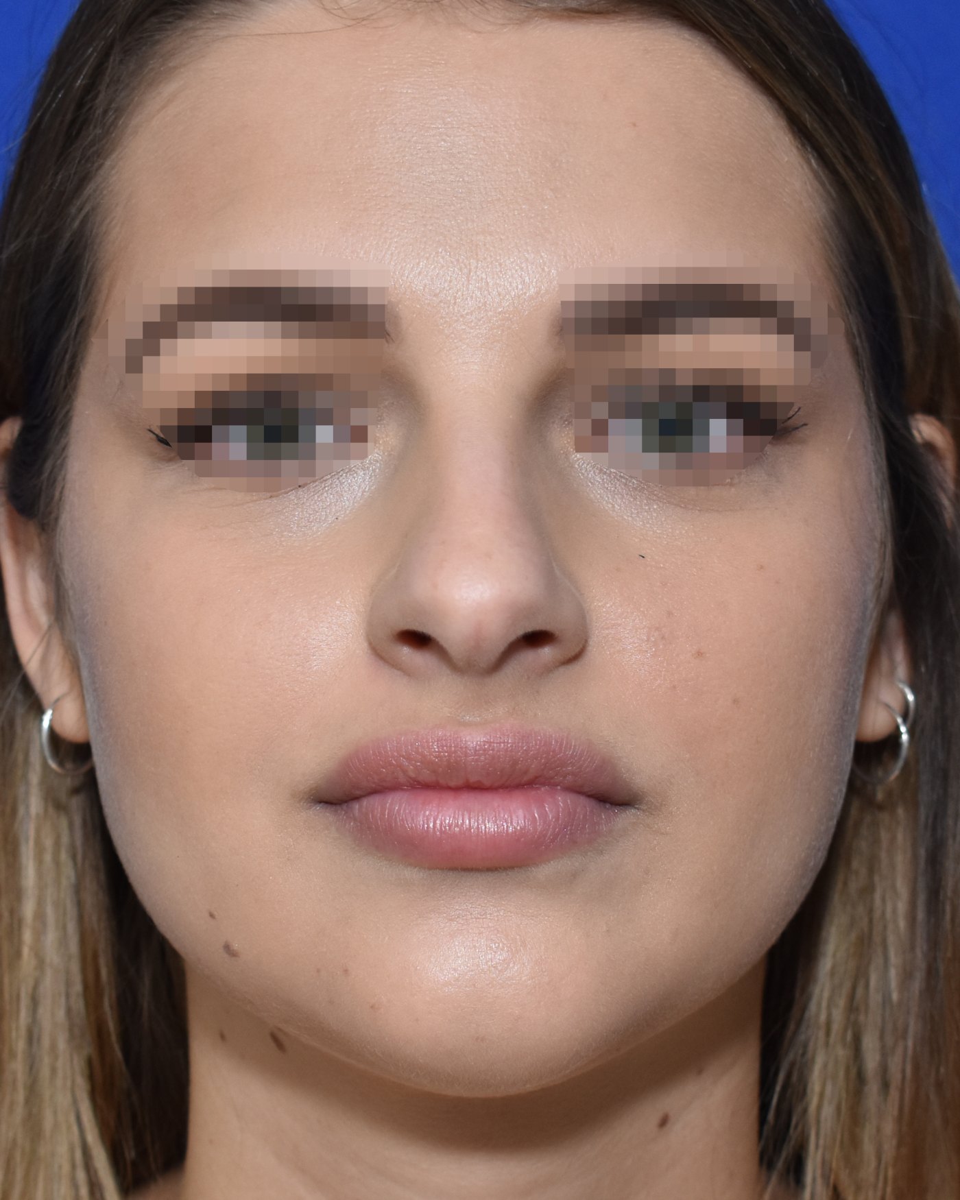 Rhinoplasty before, frontal view — Case 90017, 28 Years