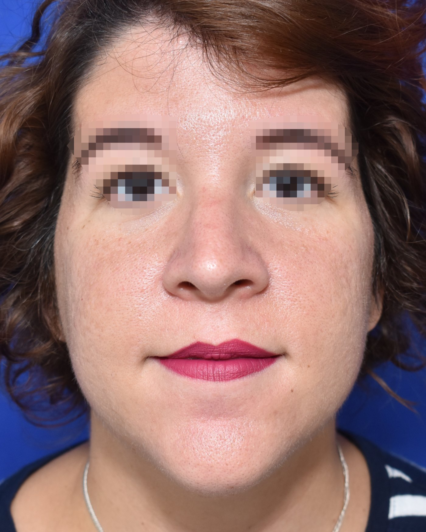 Rhinoplasty after, frontal view — Case 90018, 32 Years