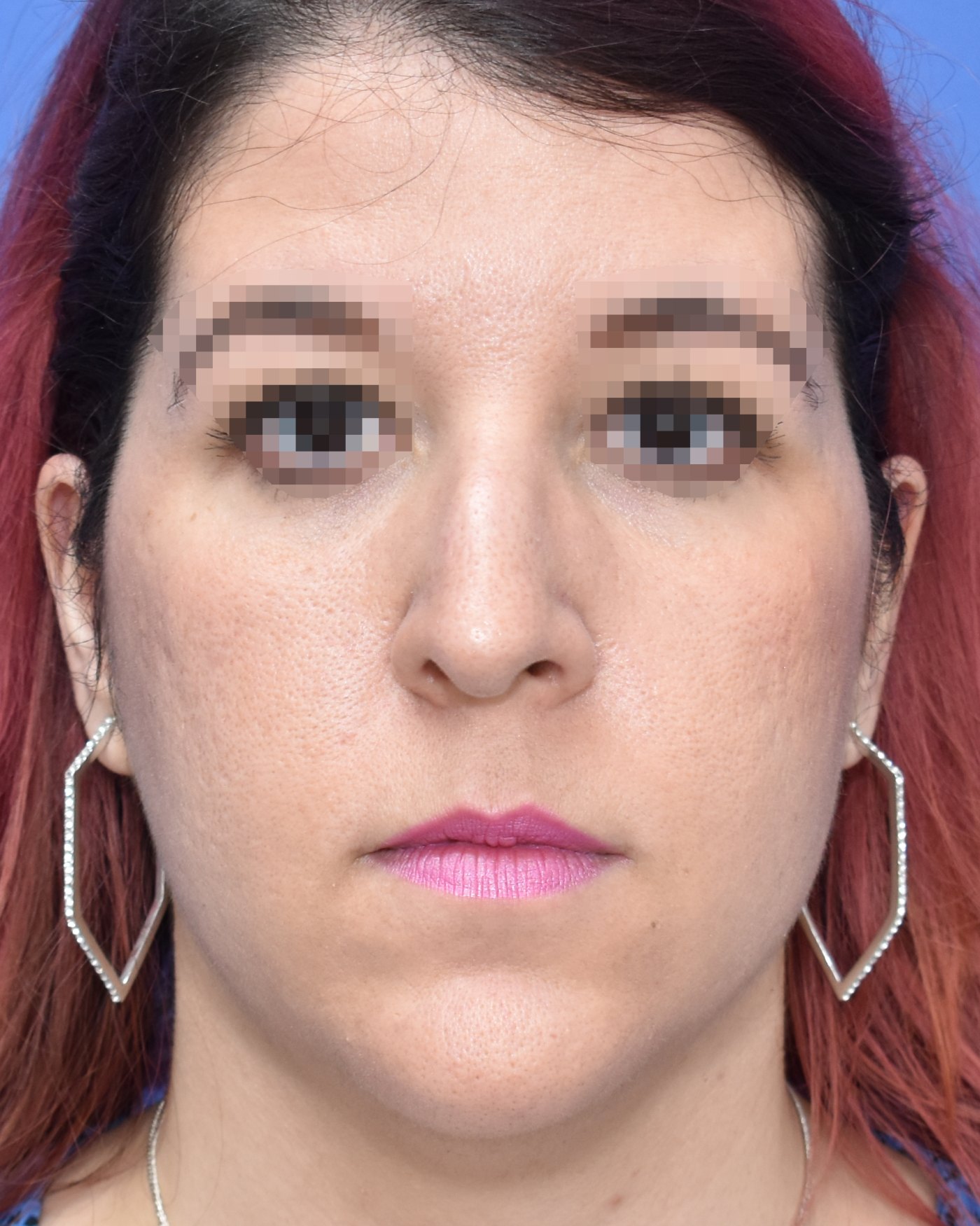 Rhinoplasty before, frontal view — Case 90018, 32 Years