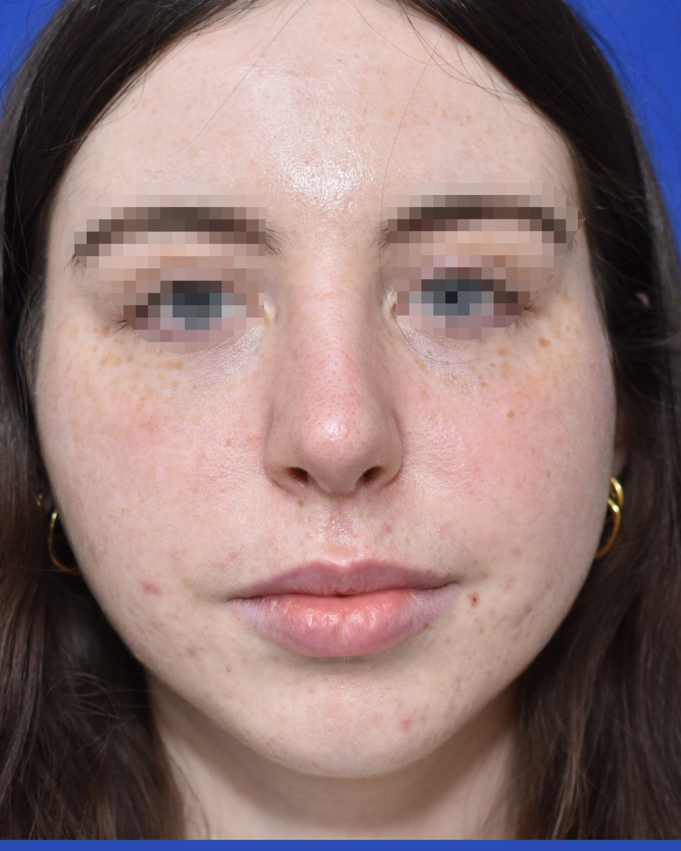 Rhinoplasty after, frontal view: Dorsal hump, Nasal tip, Wide nose, Oversized nose — Case 90020, 21 Years