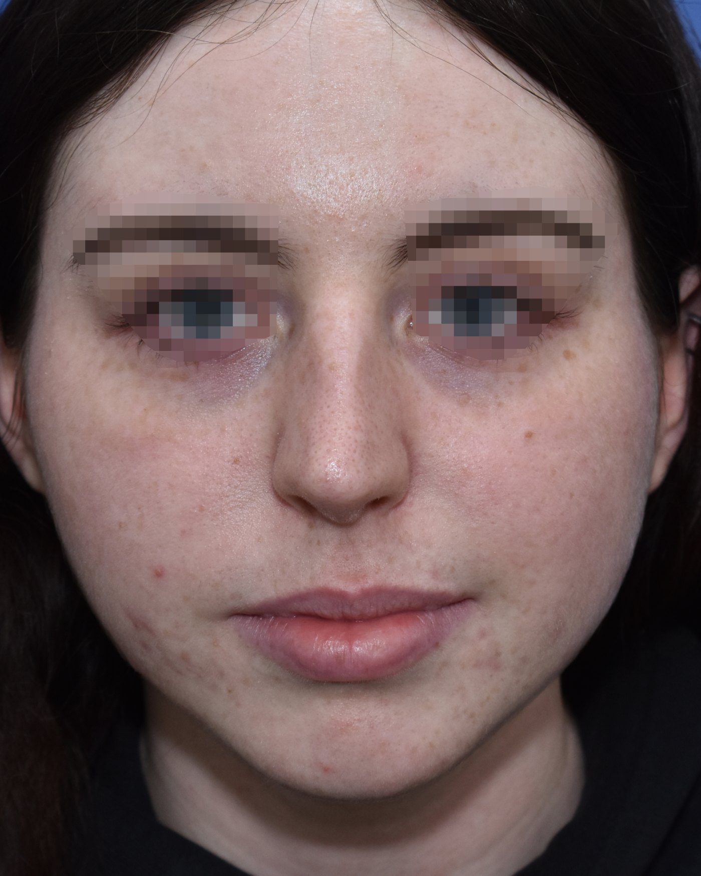 Rhinoplasty before, frontal view: Dorsal hump, Nasal tip, Wide nose, Oversized nose — Case 90020, 21 Years