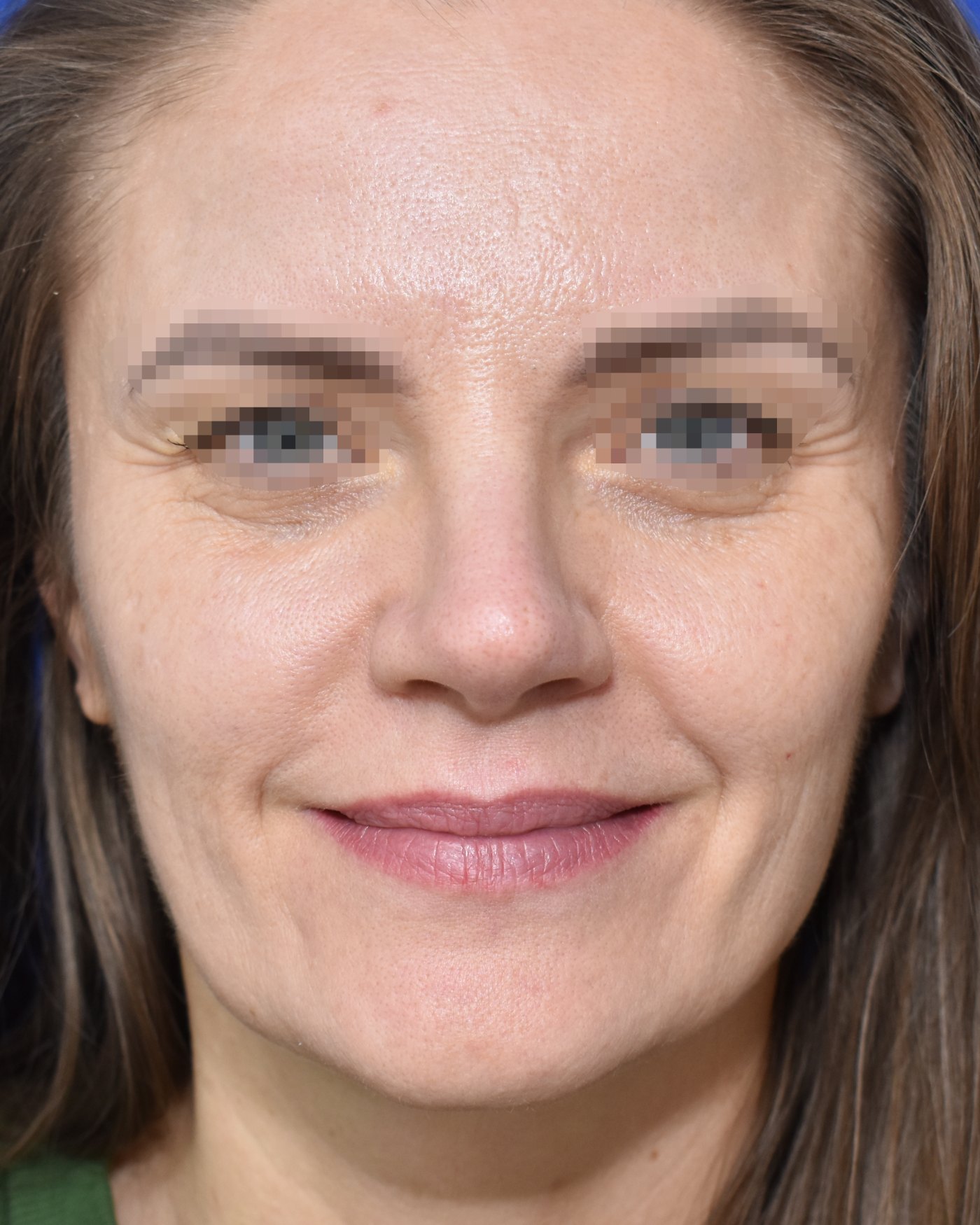 Rhinoplasty after, frontal view: Dorsal hump, Nasal tip, Wide nose, Nasal breathing — Case 90021, 43 Years