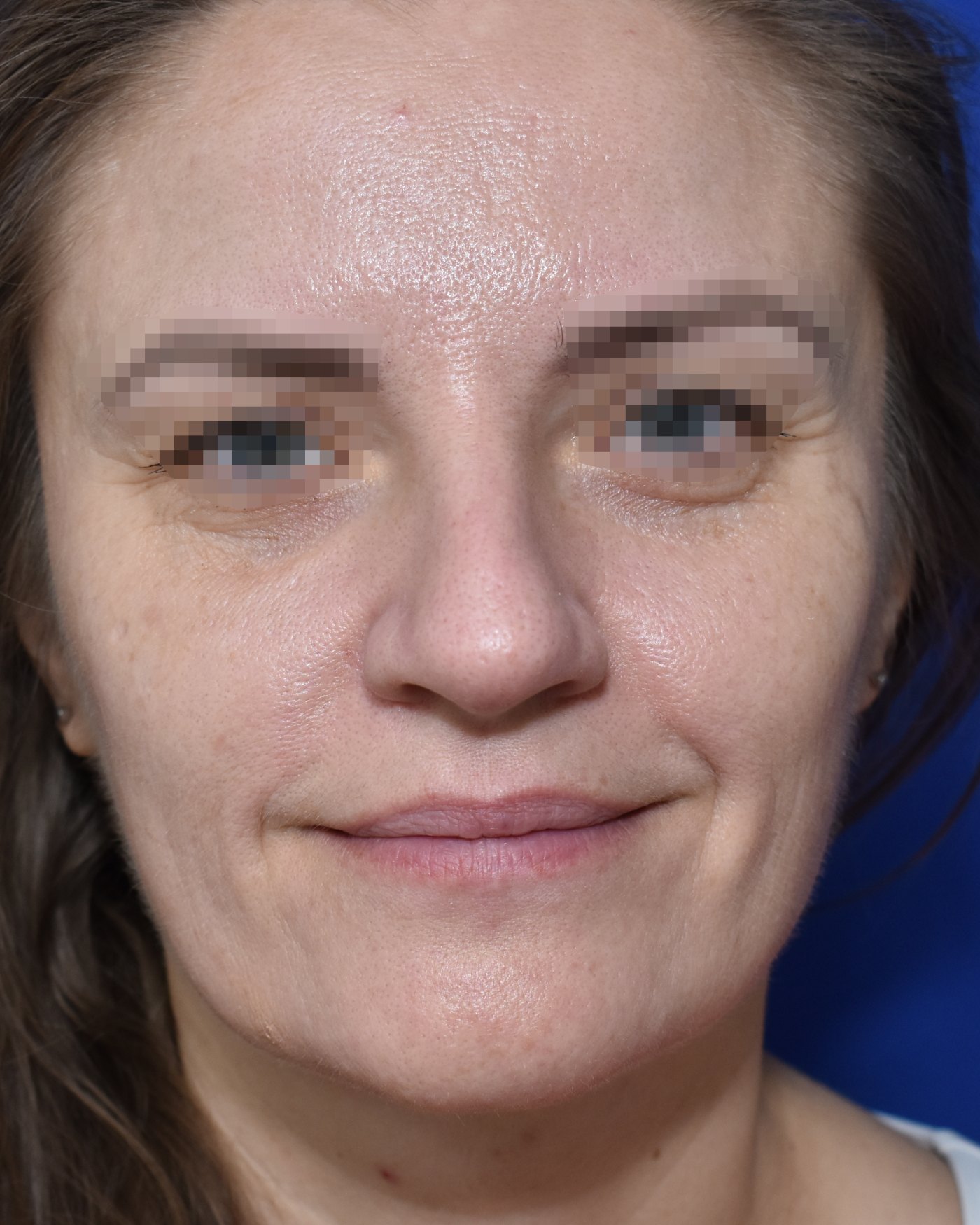 Rhinoplasty before, frontal view: Dorsal hump, Nasal tip, Wide nose, Nasal breathing — Case 90021, 43 Years
