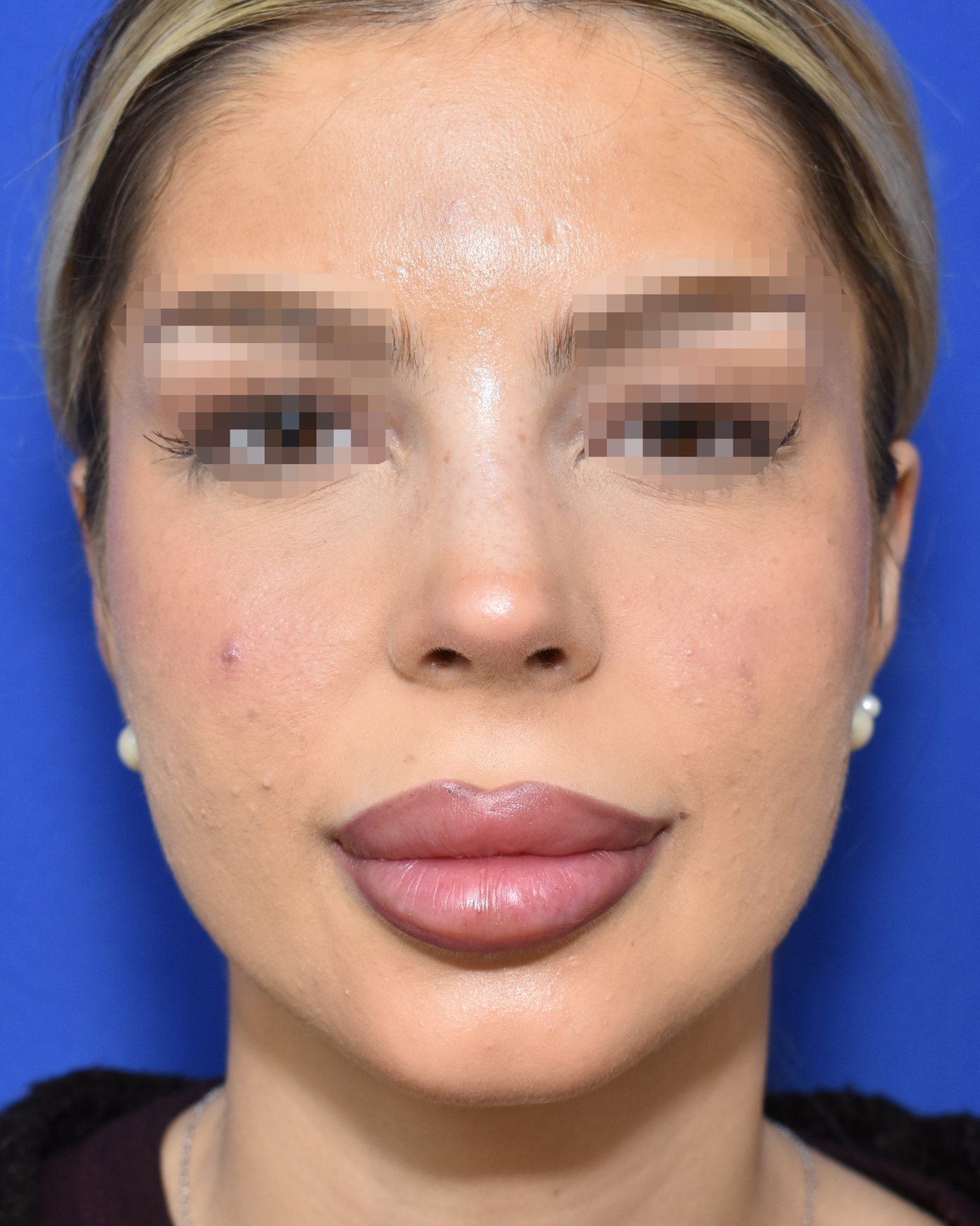 Rhinoplasty after, frontal view: Dorsal hump, Nasal tip — Case 90022, 23 Years