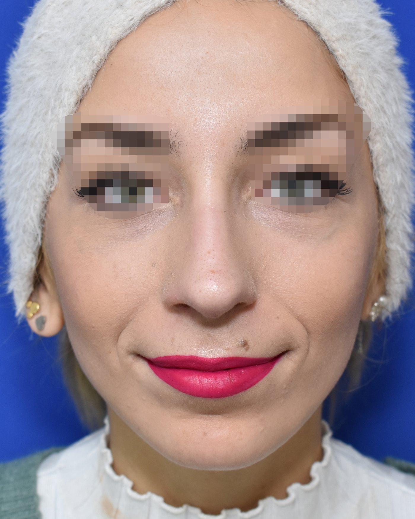 Rhinoplasty after, frontal view: Dorsal hump, Nasal tip, Crooked nose, Oversized nose, Nasal breathing — Case 90023, 23 Years