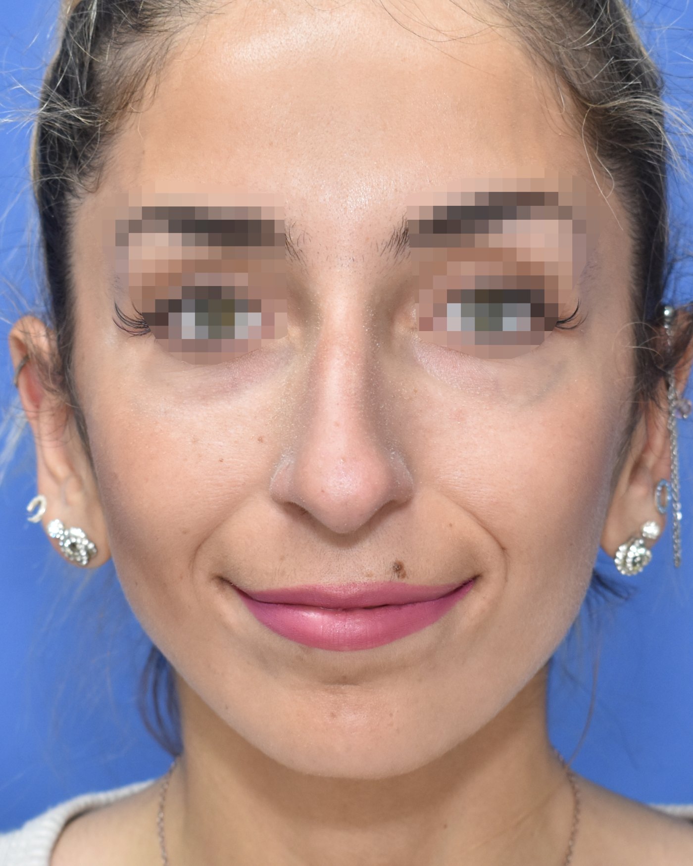 Rhinoplasty before, frontal view: Dorsal hump, Nasal tip, Crooked nose, Oversized nose, Nasal breathing — Case 90023, 23 Years
