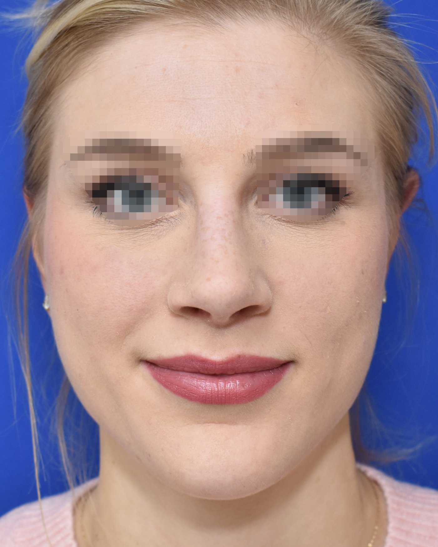 Rhinoplasty after, frontal view: Dorsal hump, Wide nose, Oversized nose — Case 90025, 29 Years