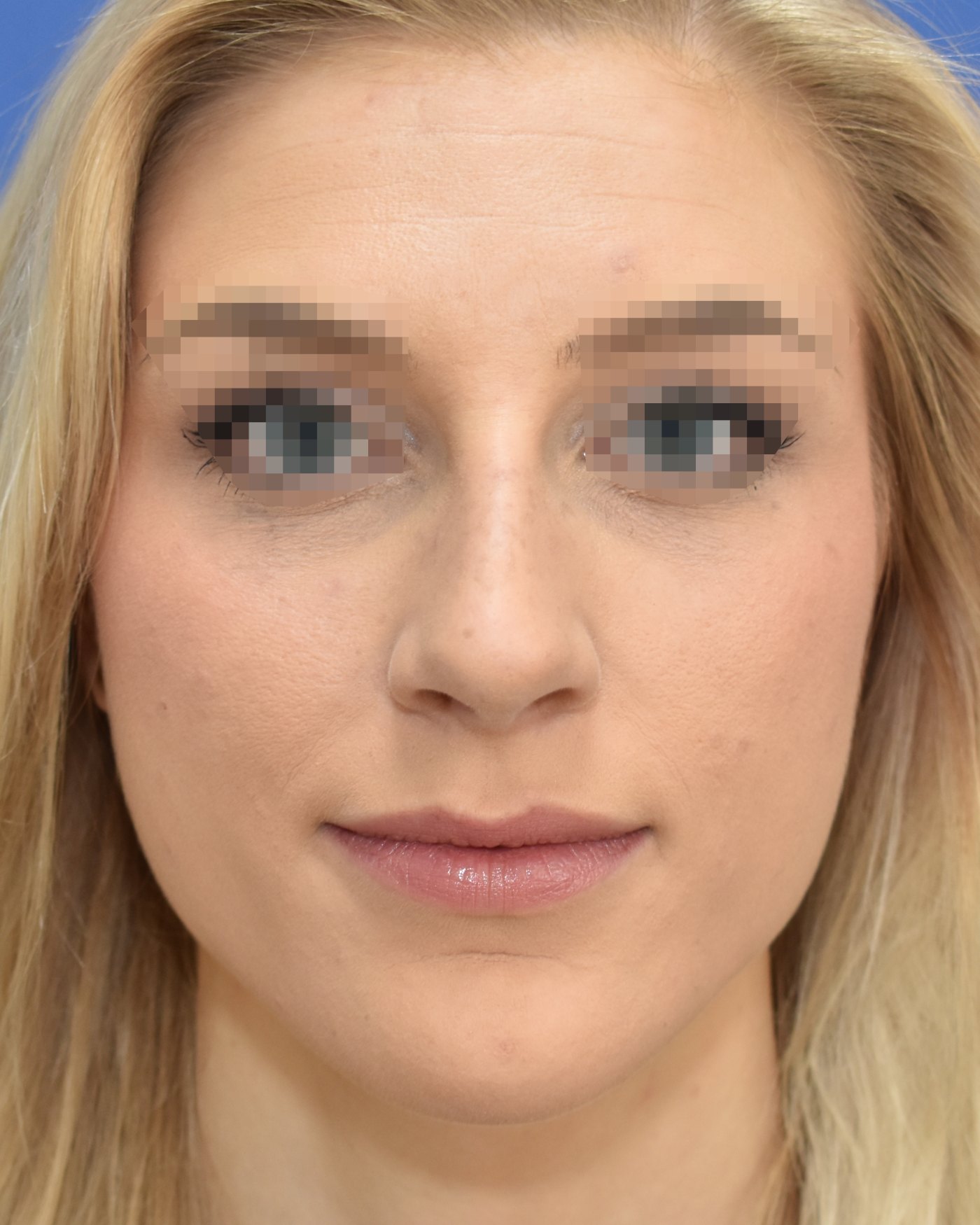 Rhinoplasty before, frontal view: Dorsal hump, Wide nose, Oversized nose — Case 90025, 29 Years