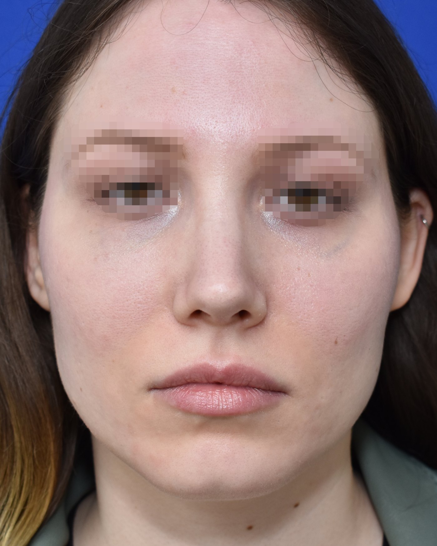Rhinoplasty after, frontal view: Nasal tip, Wide nose, Oversized nose — Case 90026, 27 Years