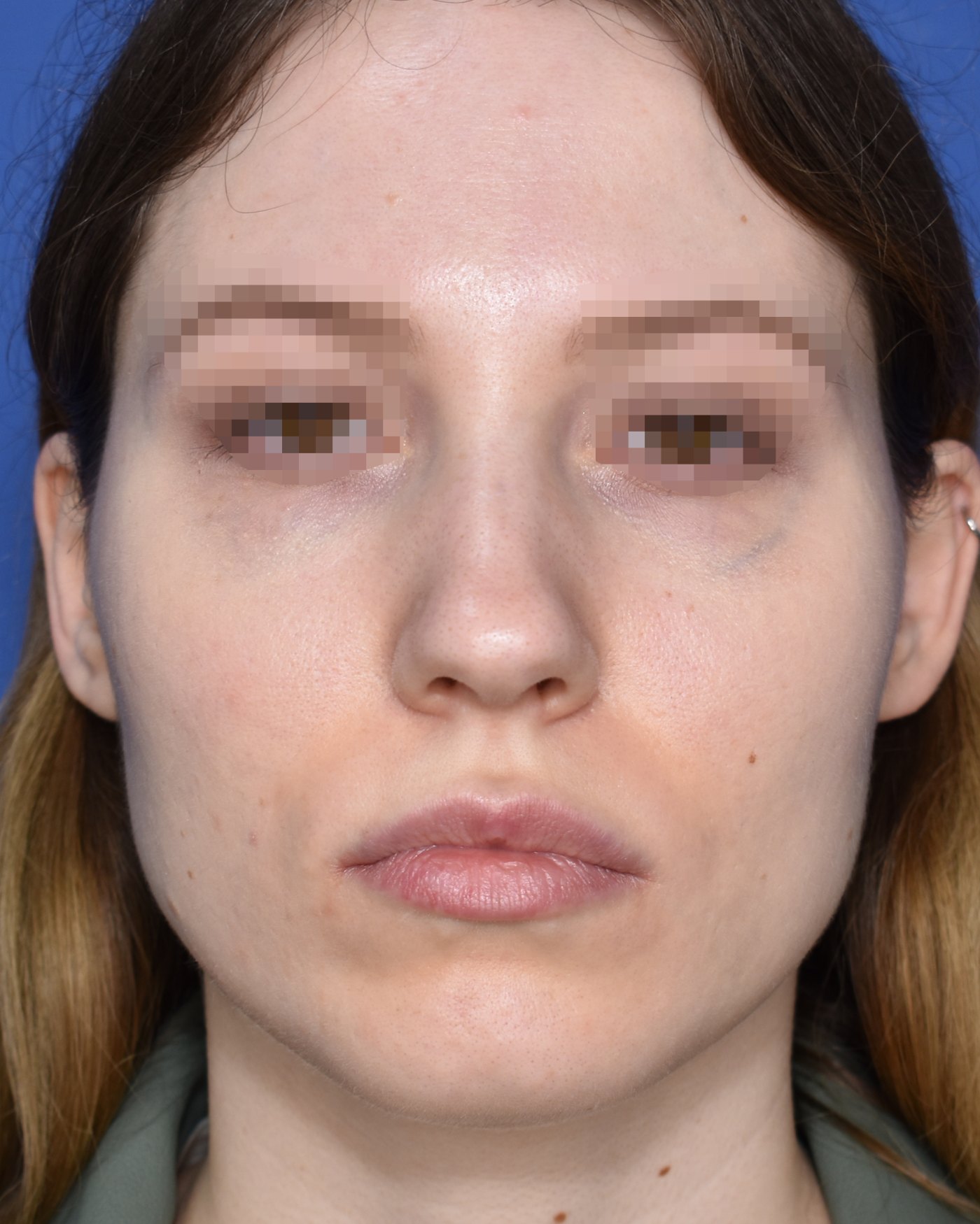 Rhinoplasty before, frontal view: Nasal tip, Wide nose, Oversized nose — Case 90026, 27 Years
