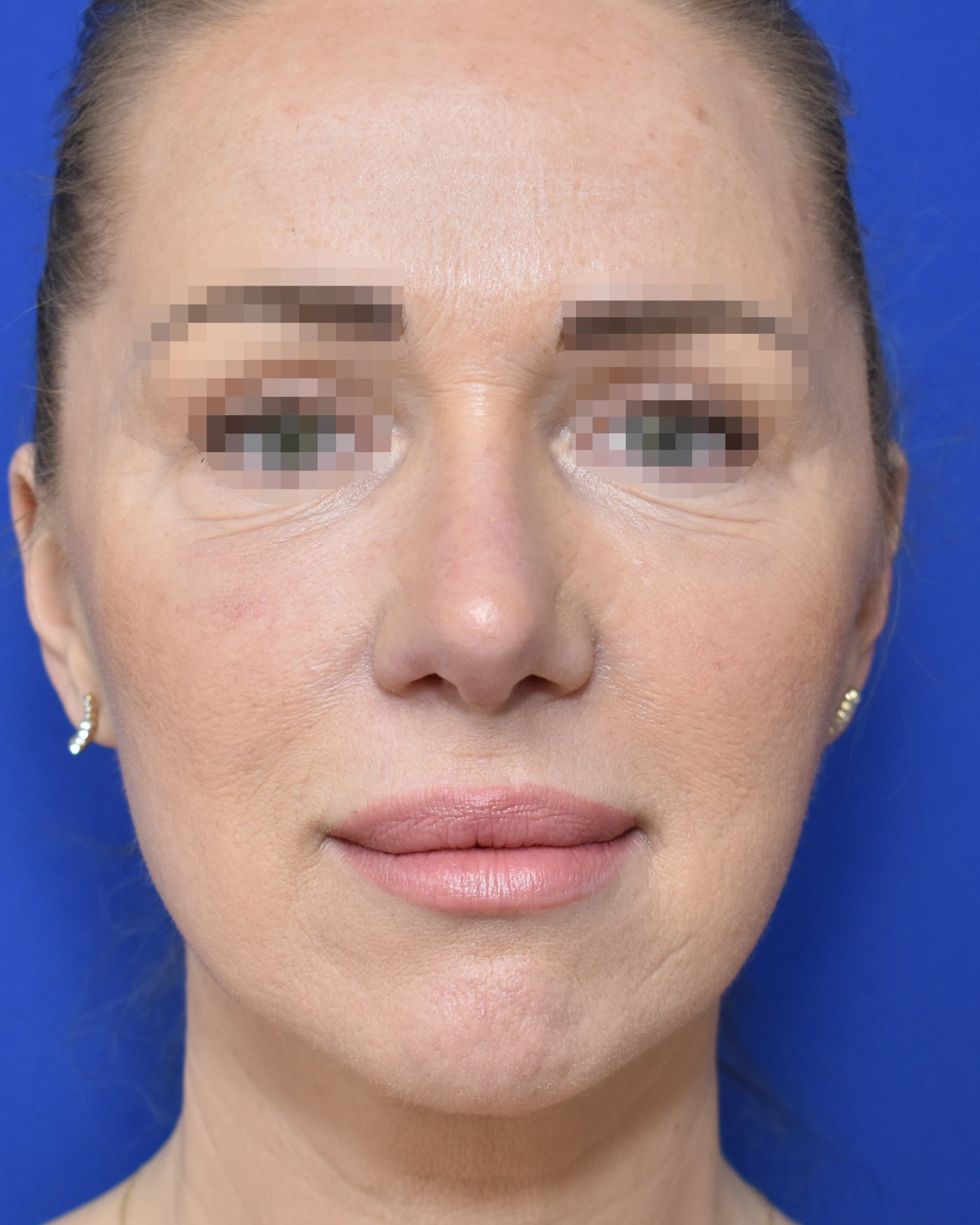 Rhinoplasty after, frontal view: Nasal tip, Wide nose, Oversized nose, Revision surgery — Case 90027, 43 Years
