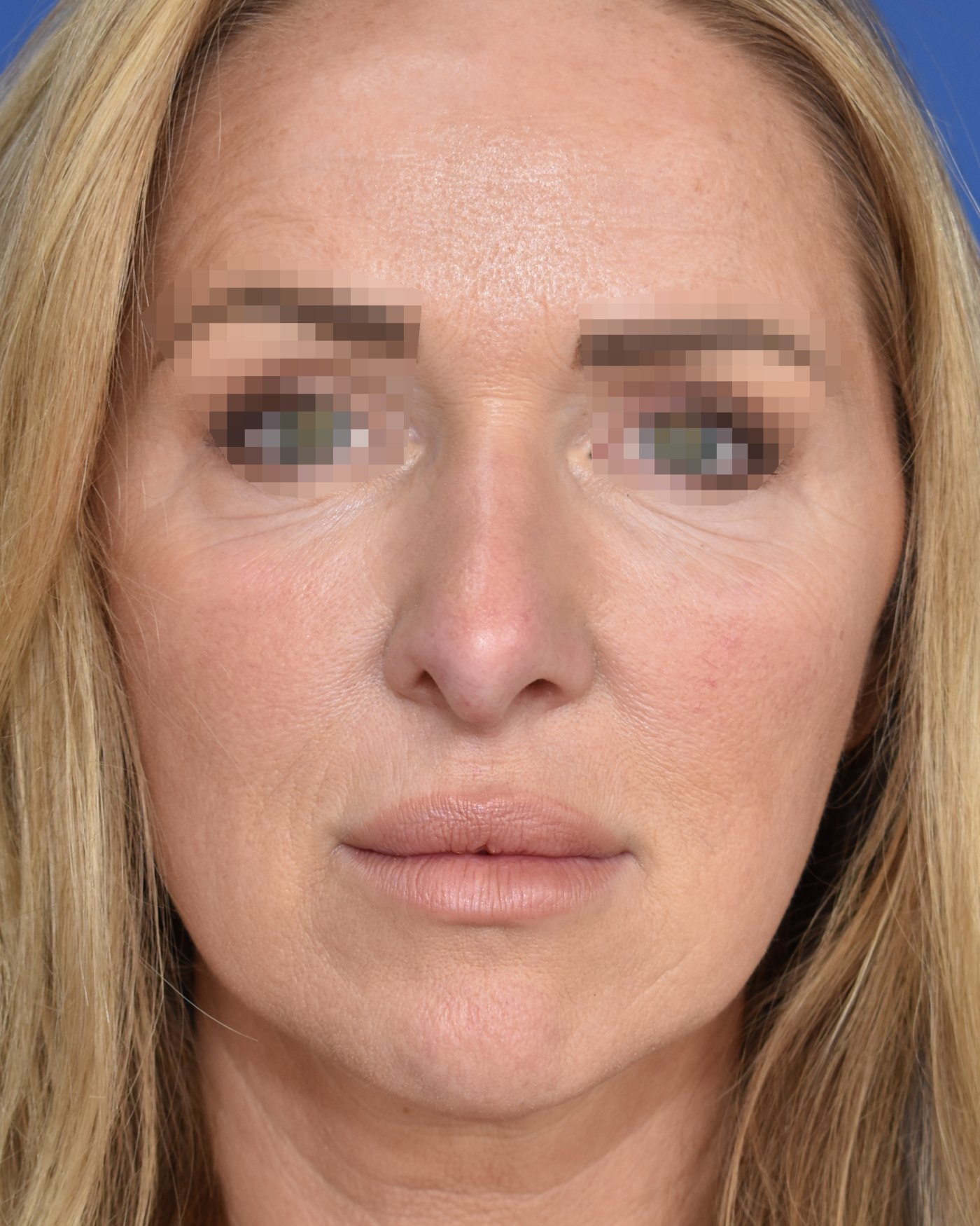 Rhinoplasty before, frontal view: Nasal tip, Wide nose, Oversized nose, Revision surgery — Case 90027, 43 Years