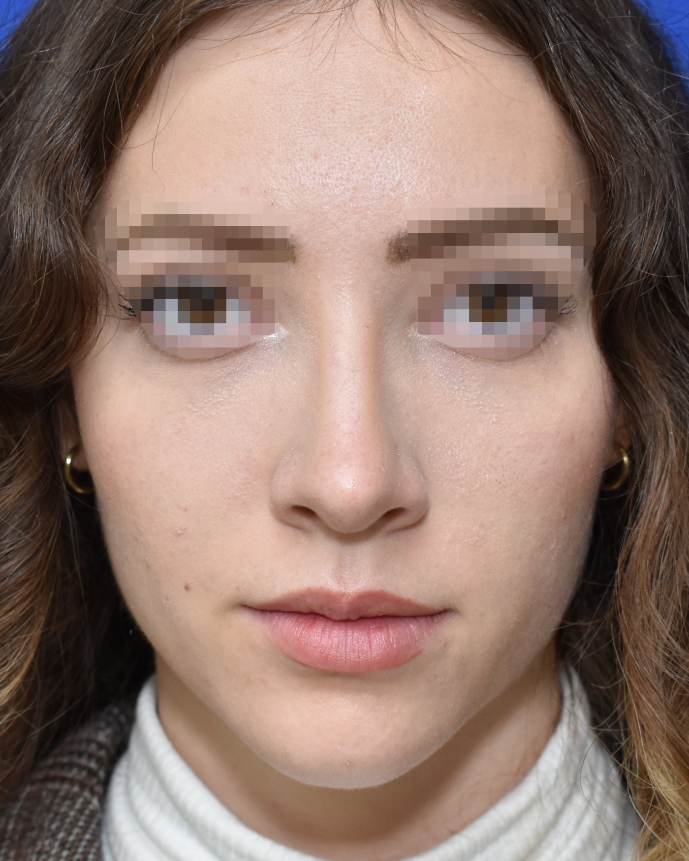 Rhinoplasty after, frontal view: Dorsal hump, Nasal tip, Crooked nose — Case 90028, 21 Years