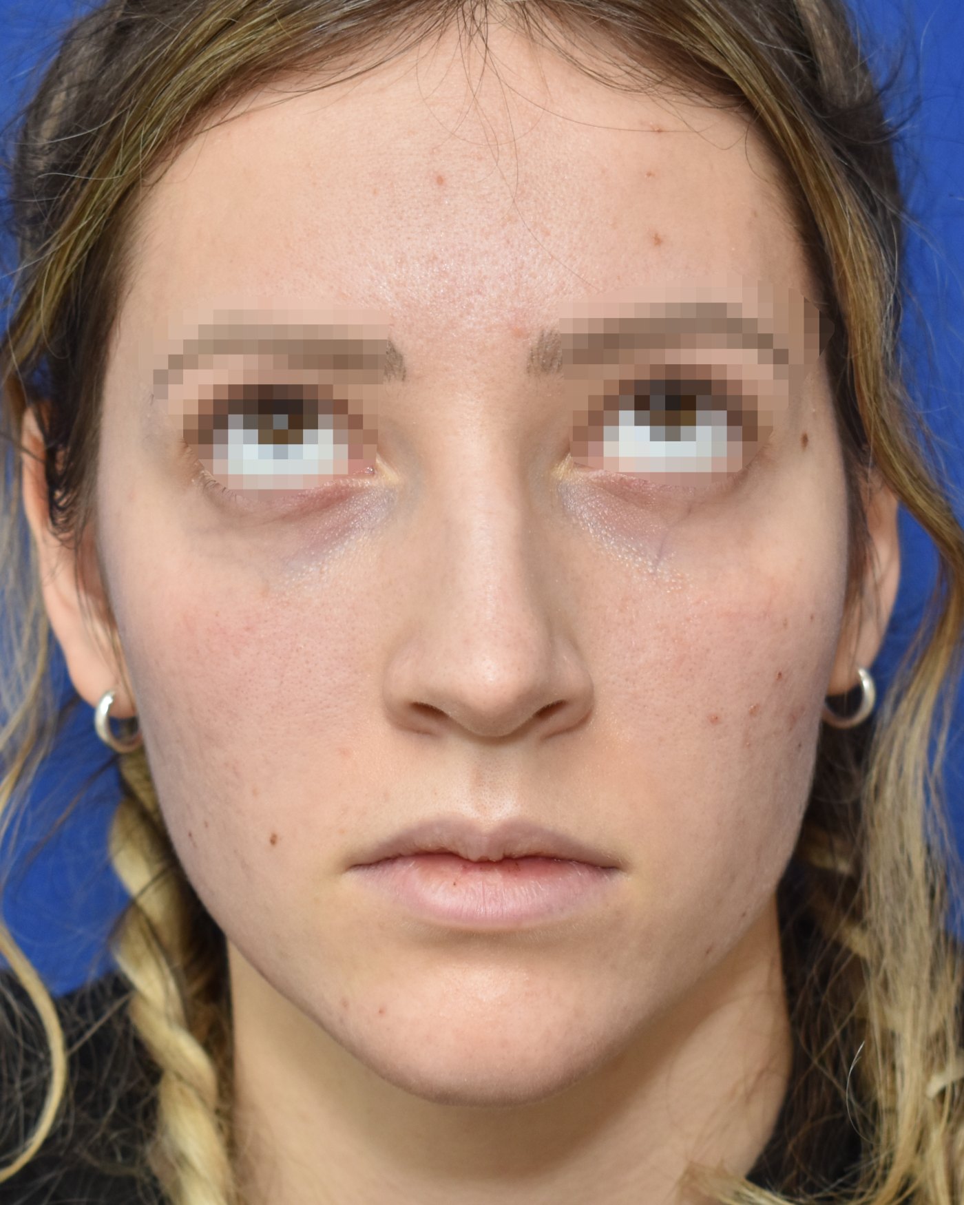 Rhinoplasty before, frontal view: Dorsal hump, Nasal tip, Crooked nose — Case 90028, 21 Years