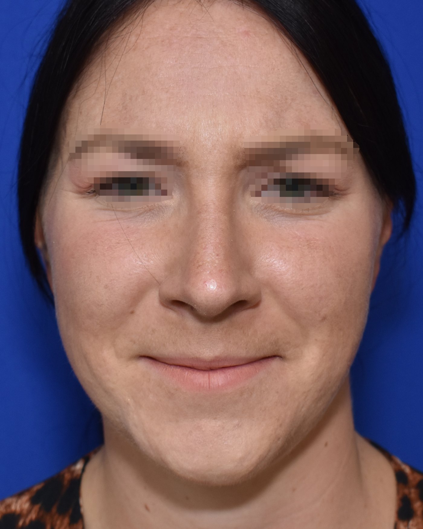 Rhinoplasty after, frontal view — Case 90029, 27 Years