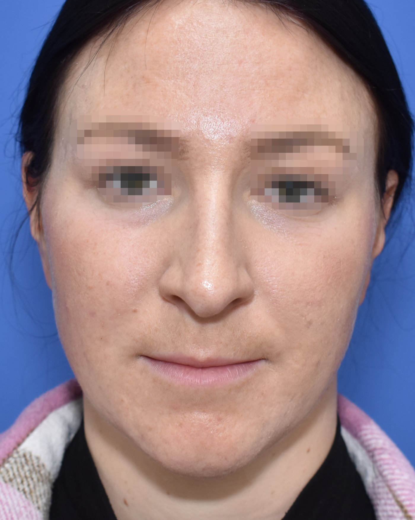 Rhinoplasty before, frontal view — Case 90029, 27 Years