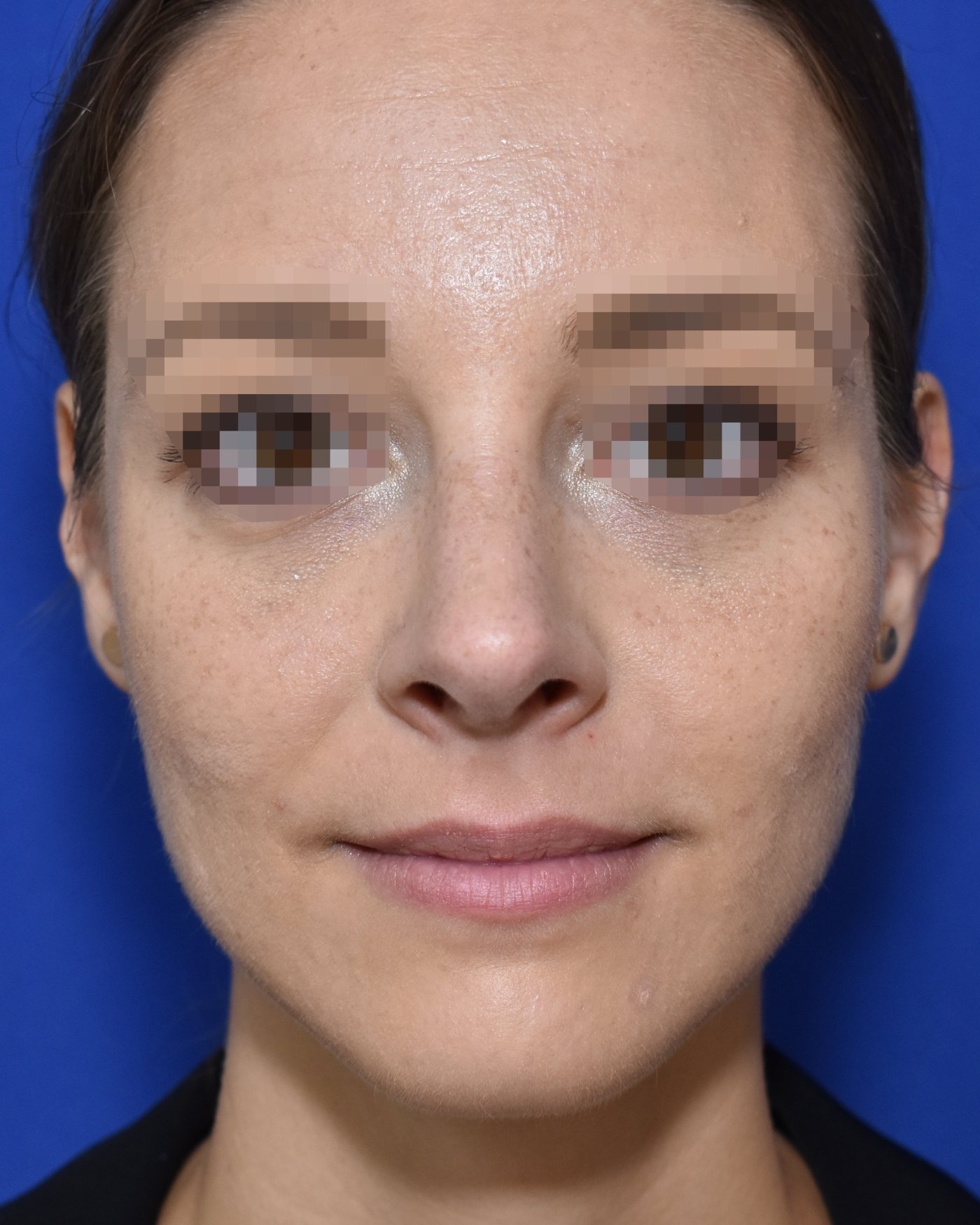 Rhinoplasty after, frontal view: Dorsal hump, Nasal tip, Wide nose, Oversized nose — Case 90030, 31 Years
