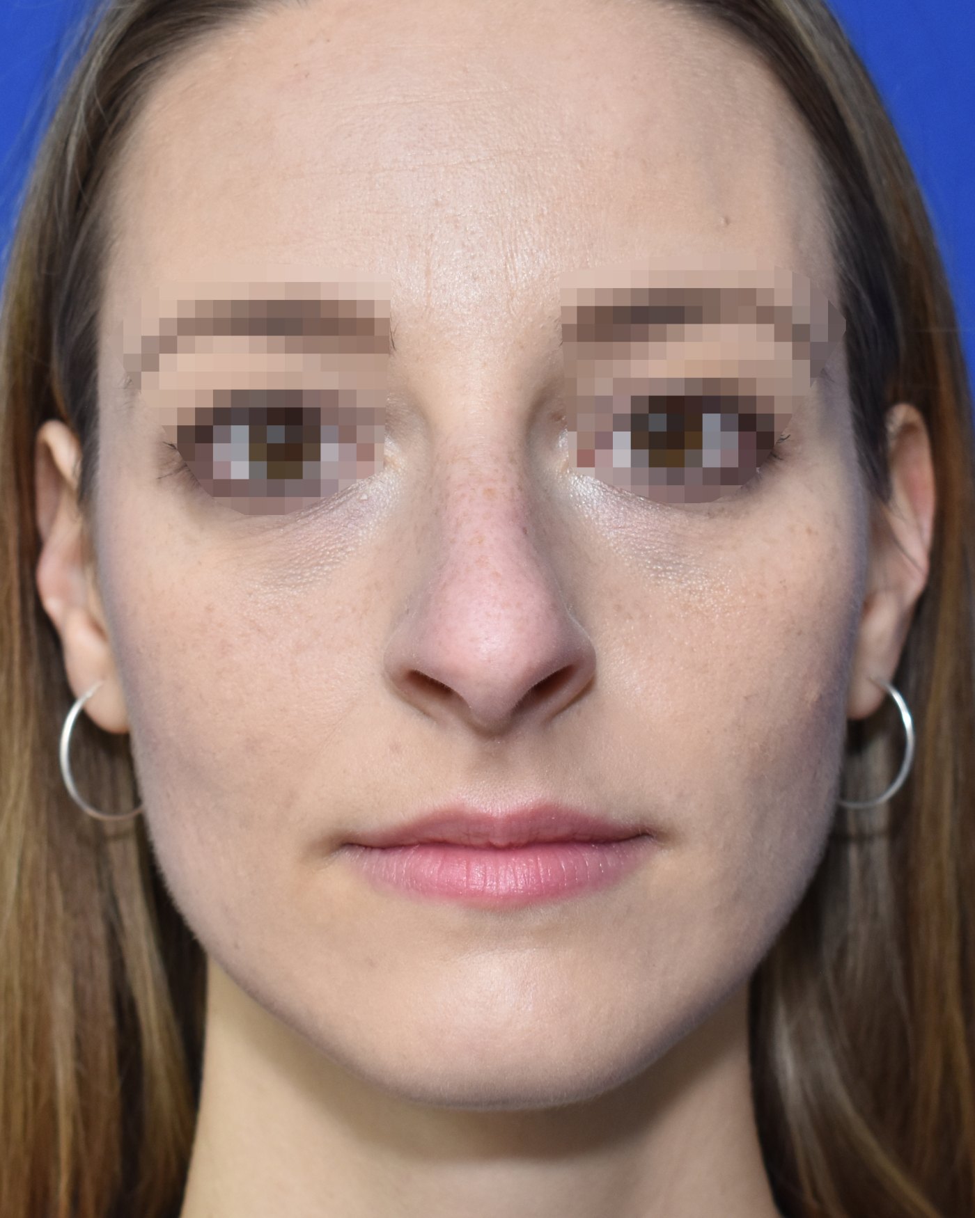 Rhinoplasty before, frontal view: Dorsal hump, Nasal tip, Wide nose, Oversized nose — Case 90030, 31 Years