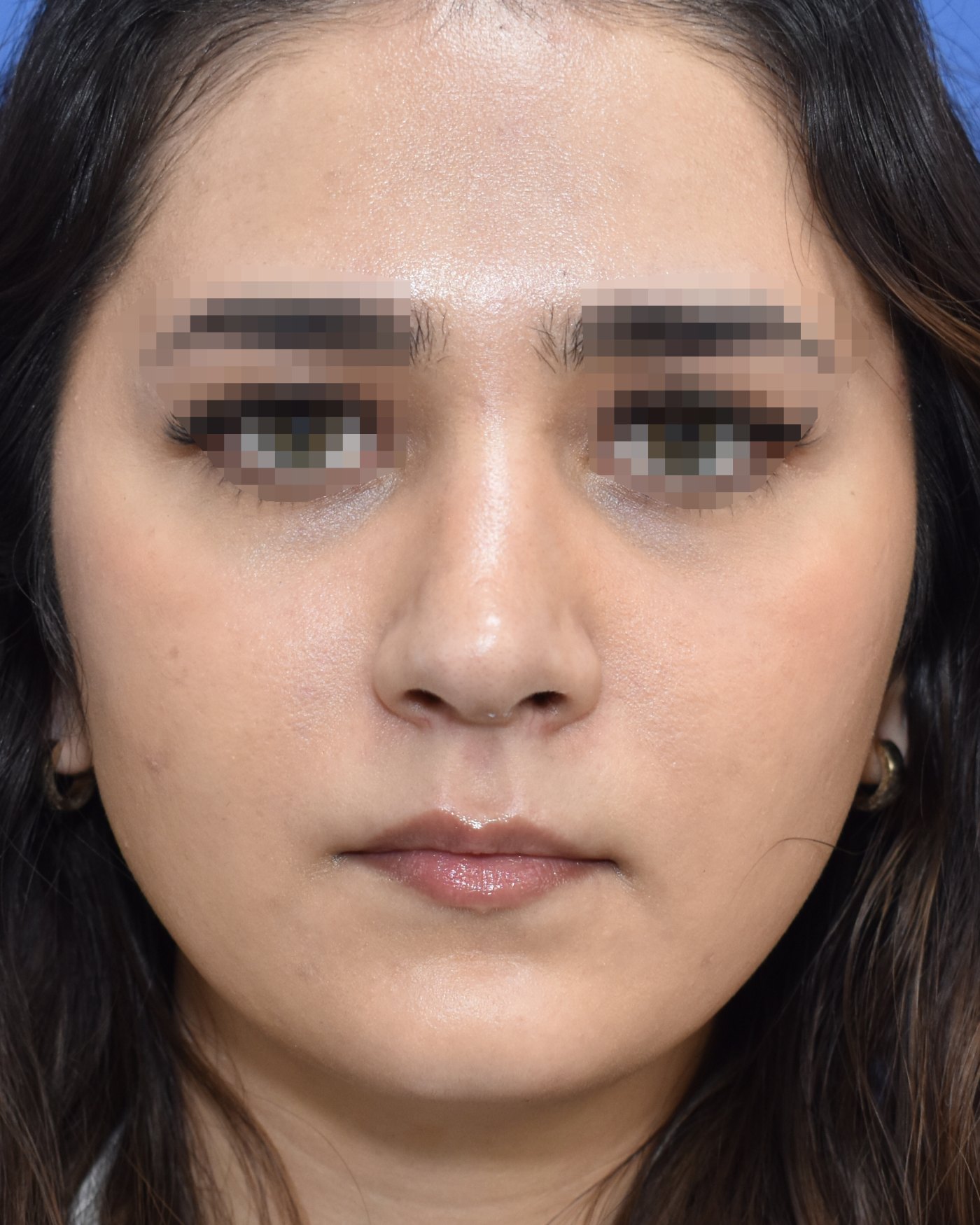 Rhinoplasty after, frontal view: Dorsal hump, Nasal tip, Crooked nose, Wide nose — Case 90031, 26 Years