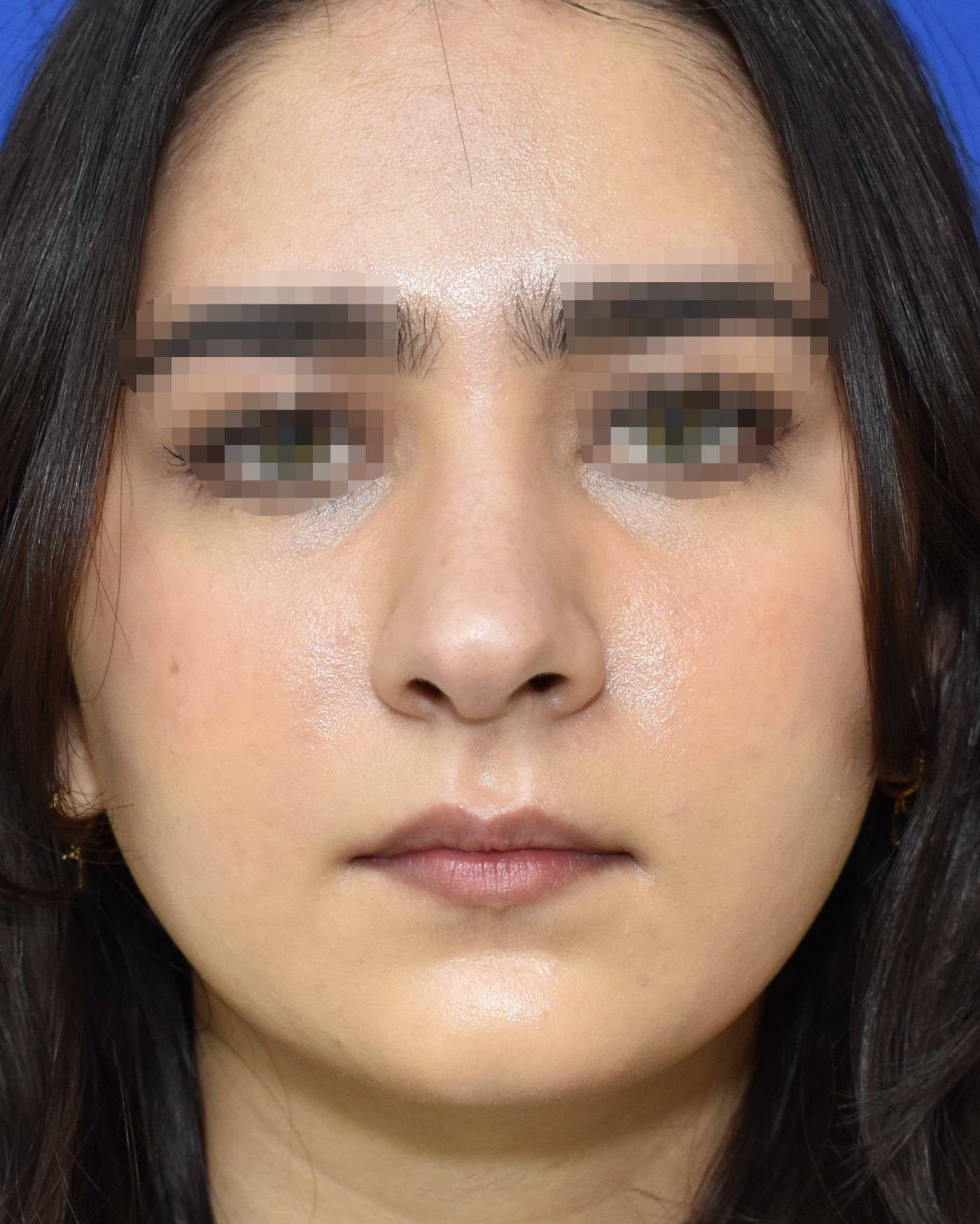 Rhinoplasty before, frontal view: Dorsal hump, Nasal tip, Crooked nose, Wide nose — Case 90031, 26 Years