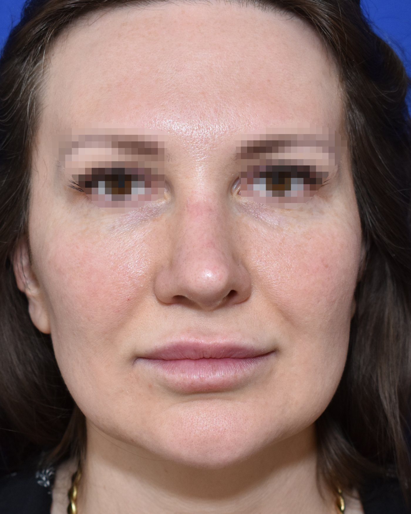 Rhinoplasty after, frontal view: Nasal tip, Revision surgery — Case 90032, 35 Years