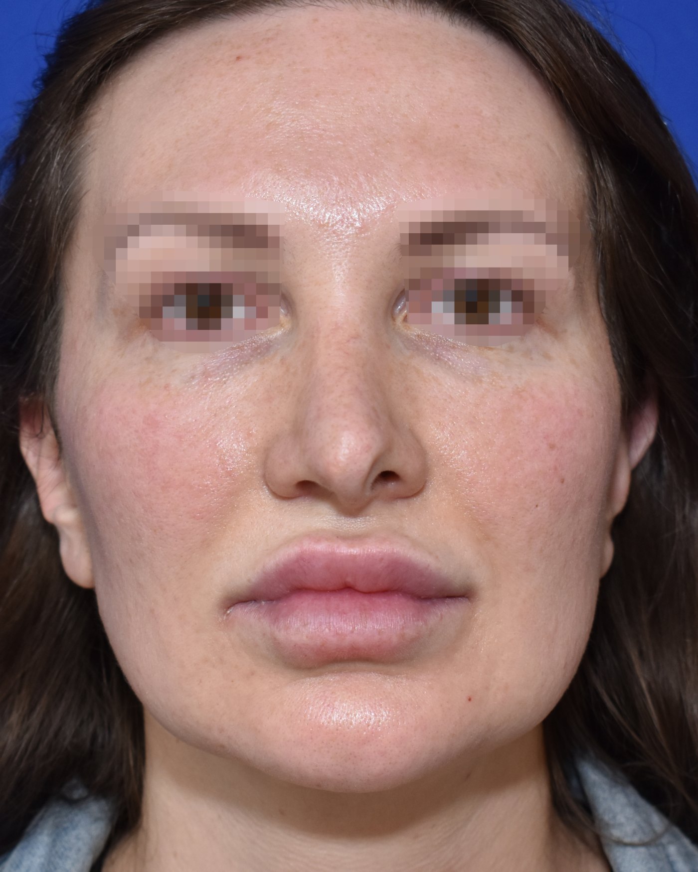 Rhinoplasty before, frontal view: Nasal tip, Revision surgery — Case 90032, 35 Years