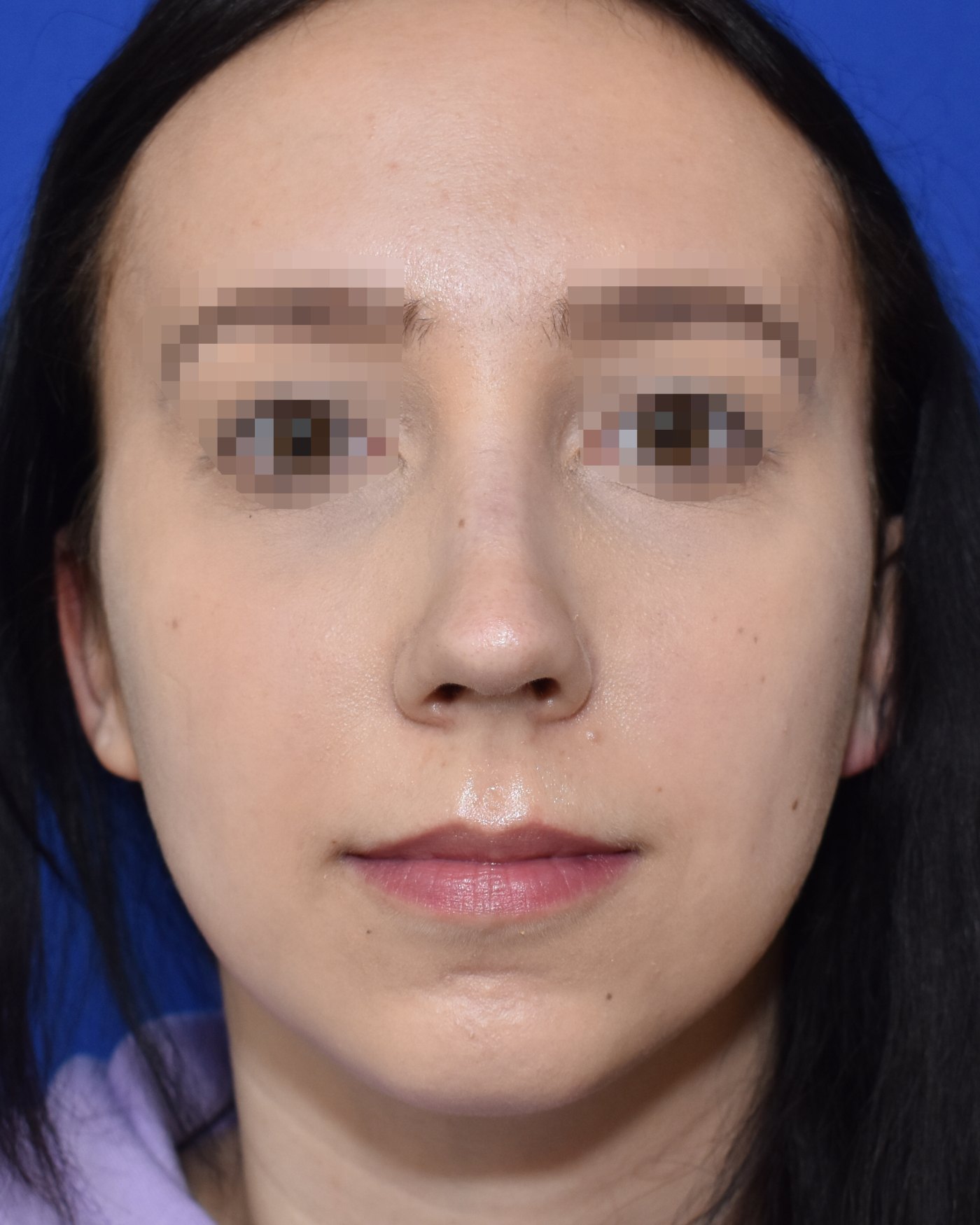 Rhinoplasty after, frontal view — Case 90033, 25 Years