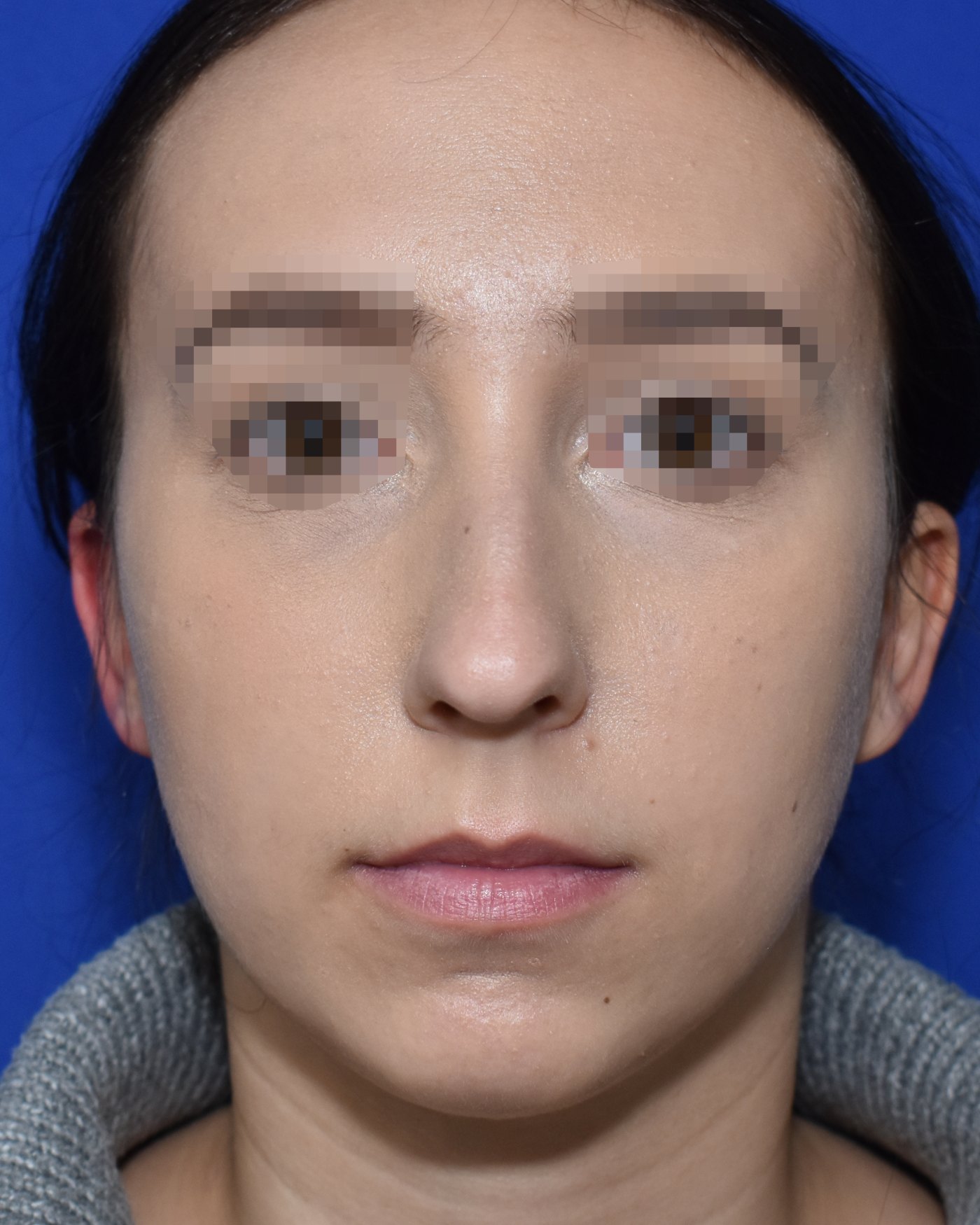 Rhinoplasty before, frontal view — Case 90033, 25 Years