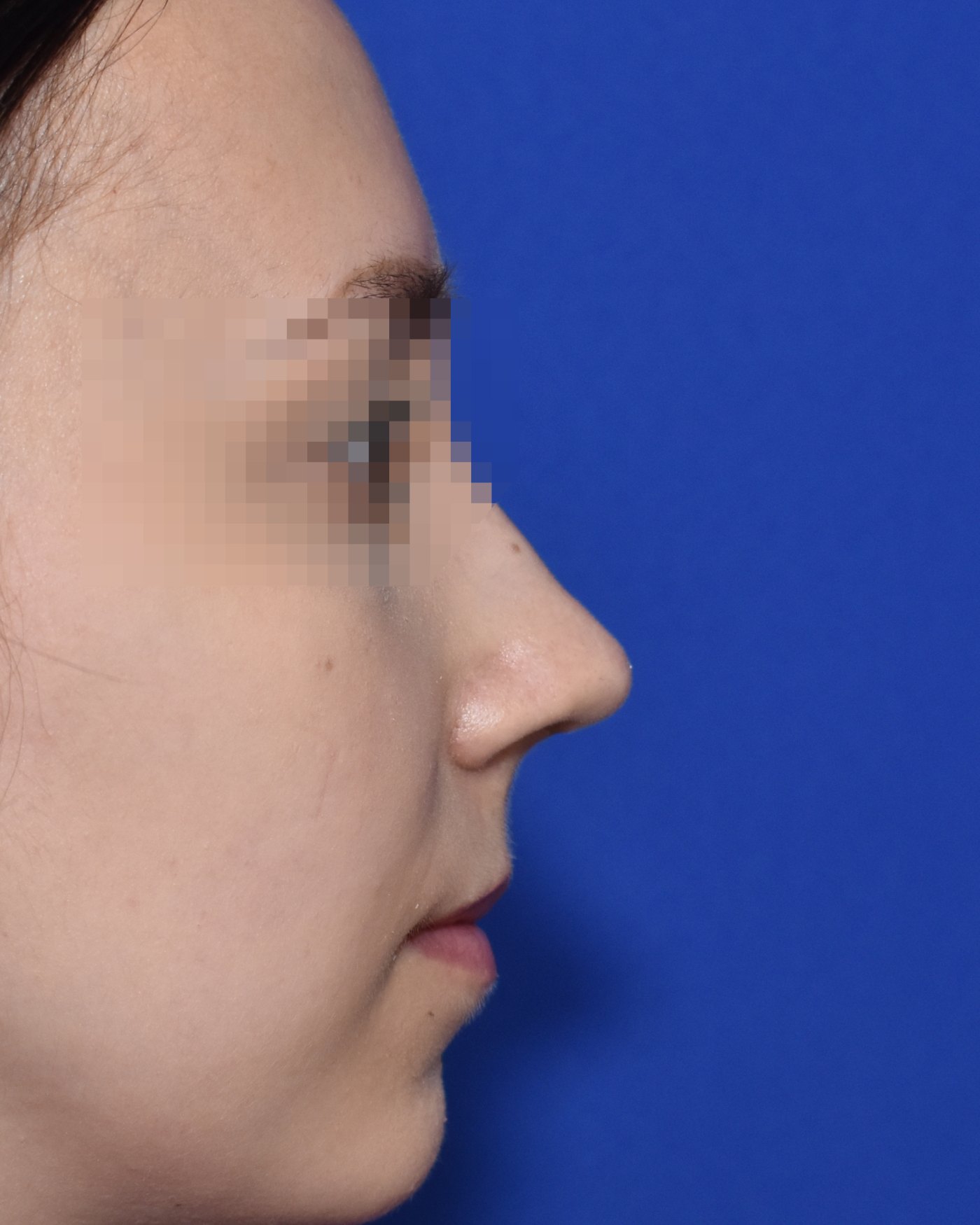 Rhinoplasty after, profile view — Case 90033, 25 Years